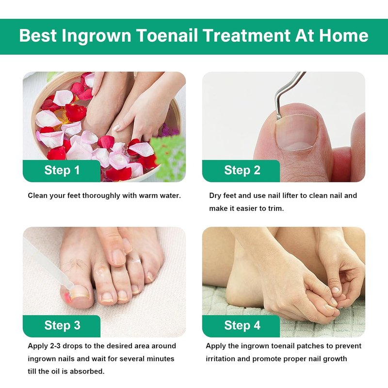 Ingrown Toenail Treatment Kit - Relieve Pain & Repair Issues | Safe Home Solution