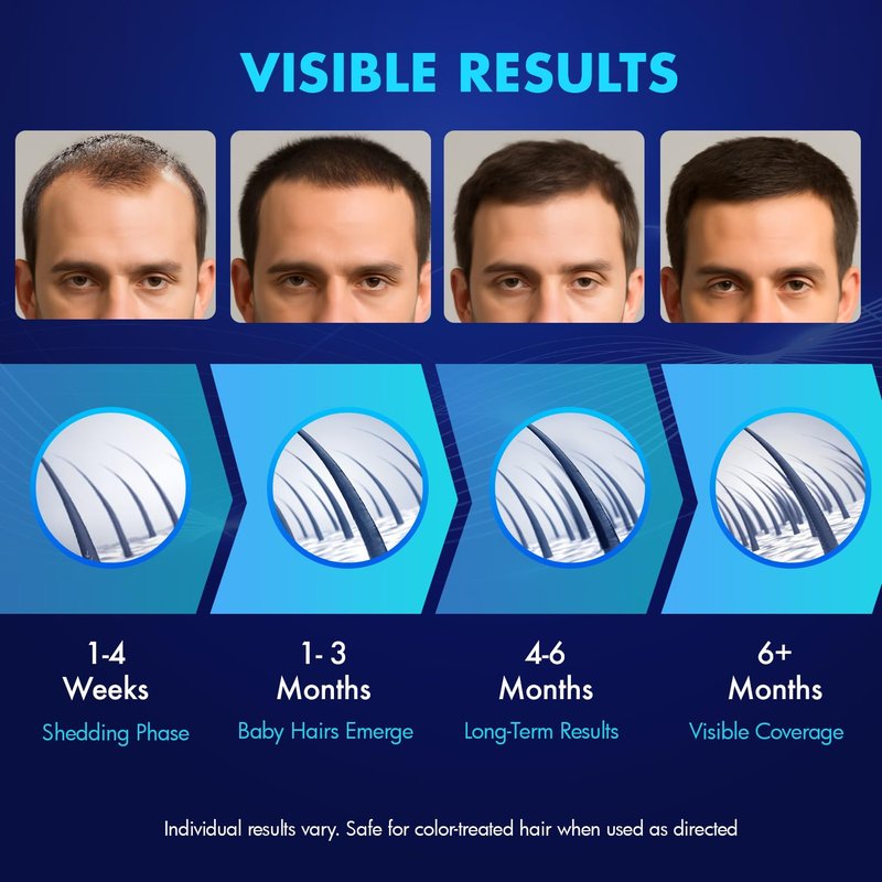 5% Minoxidil Hair Growth for Men and Women: Extra Strength Minoxidil Topical Solution for Adults with Receding Hairlines or Vertex Thinning - Hair Loss Treatment Serum with Biotin for Daily Scalp Use