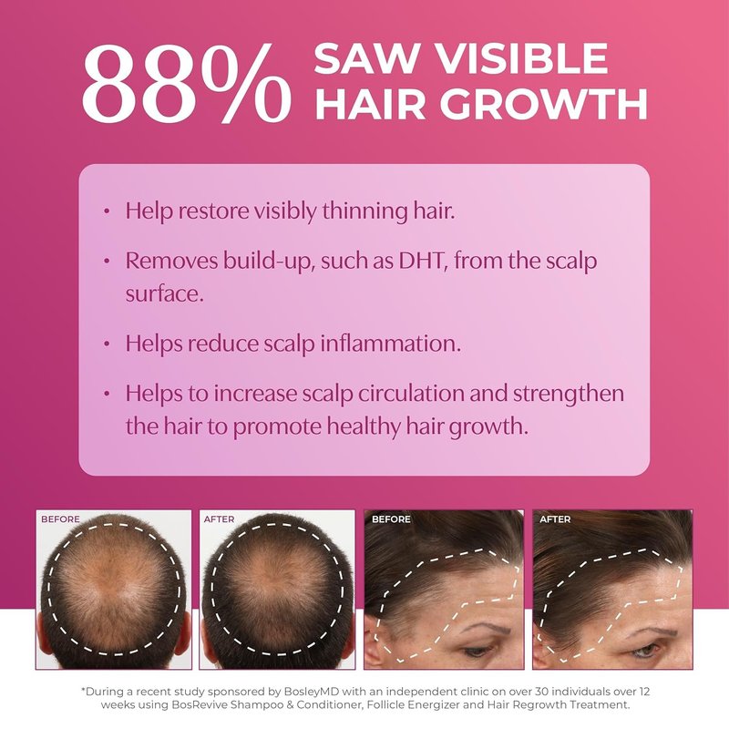 BosleyMD Women’s Hair Regrowth Treatment Foam – Minoxidil 5% Extra Strength, Clinically Proven Hair Growth & Hair Loss Treatment, No-Drip Scalp Application, Fast Absorbing, 2 Month Supply (2.11 oz)