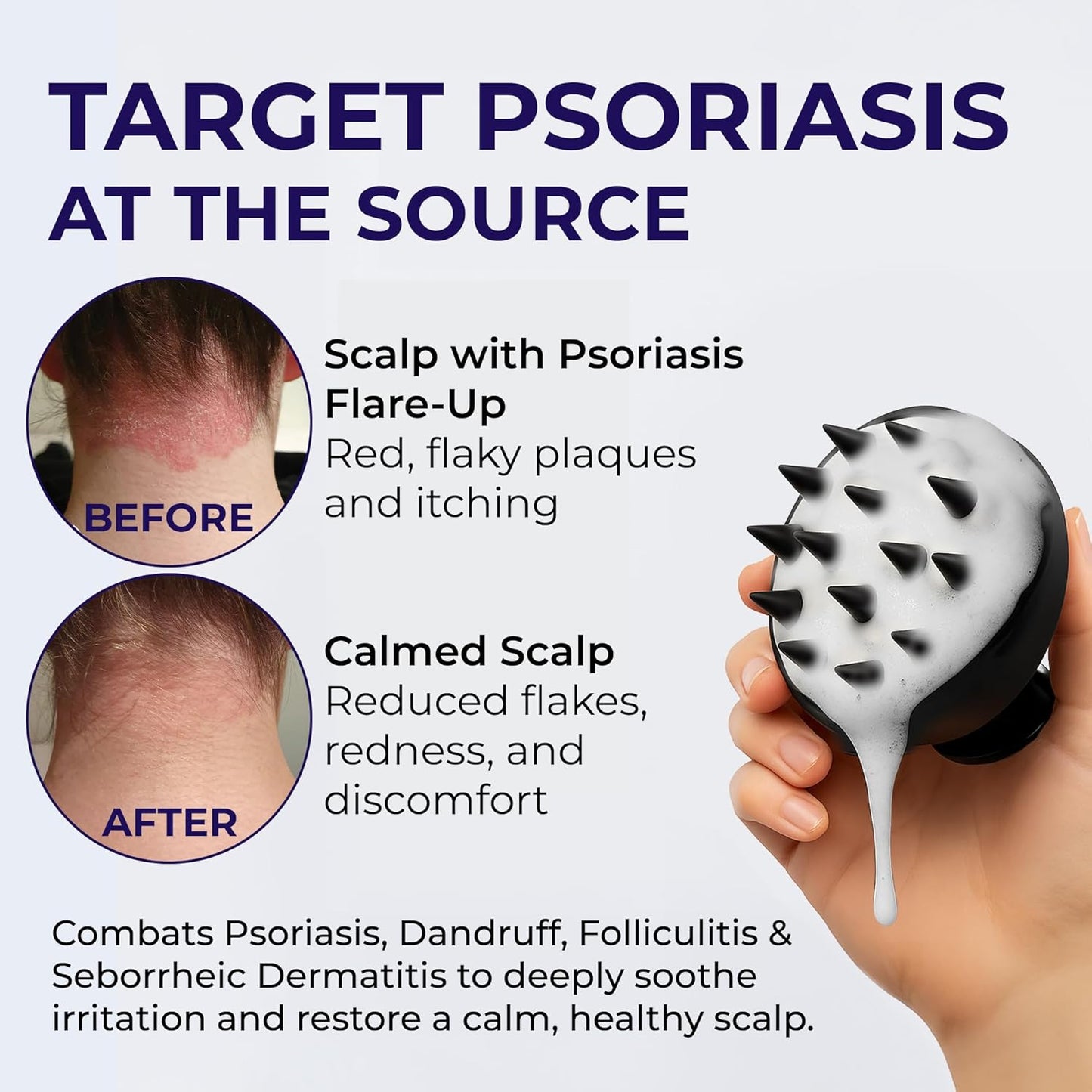 Psoriasis Shampoo - Medicated Anti-Dandruff Treatment for Flakes & Seborrheic Dermatitis | 200ml