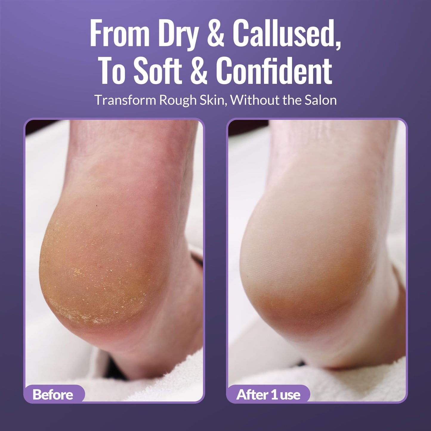 Footlogix Foot Care Callus Softener Combo - Callus Remover Spray & Double-Sided Foot File for Dry, Cracked Heels, Pedicure Tools for Feet, Foot Exfoliator