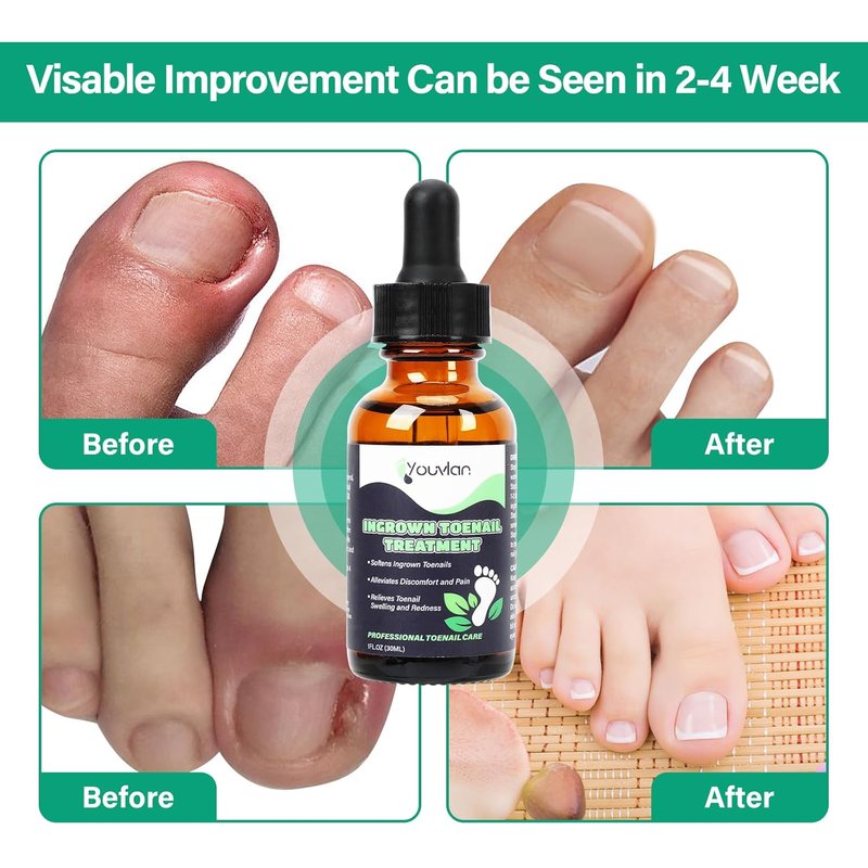 Ingrown Toenail Treatment Kit - Relieve Pain & Repair Issues | Safe Home Solution