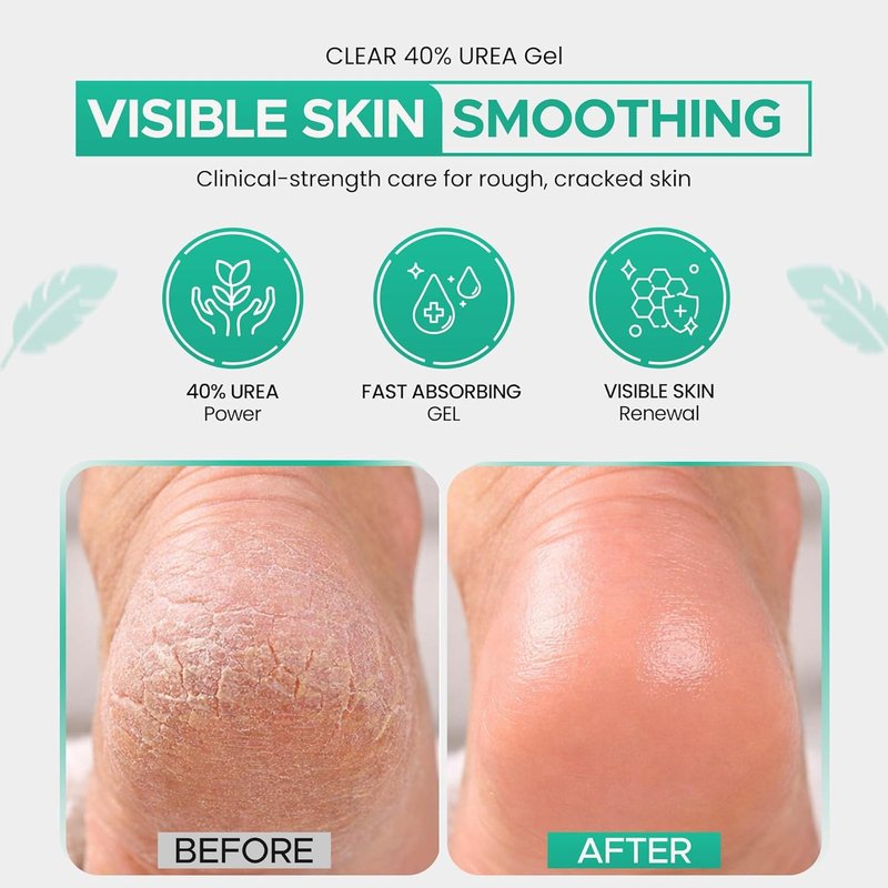 Urea Gel 40% with Tea Tree & Coconut Oil - Intensive Moisturizing Exfoliating Gel for Dry Skin | 8 oz