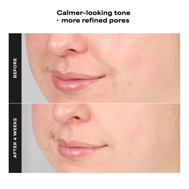 Paula’s Choice CALM 1% Sensitive Skin BHA Exfoliant, Salicylic Acid Lotion for Large, Clogged Pores, Calms, Soothes Redness, Suitable for Rosacea-Prone, Eczema-Prone Skin, Fragrance-Free, 3.3oz