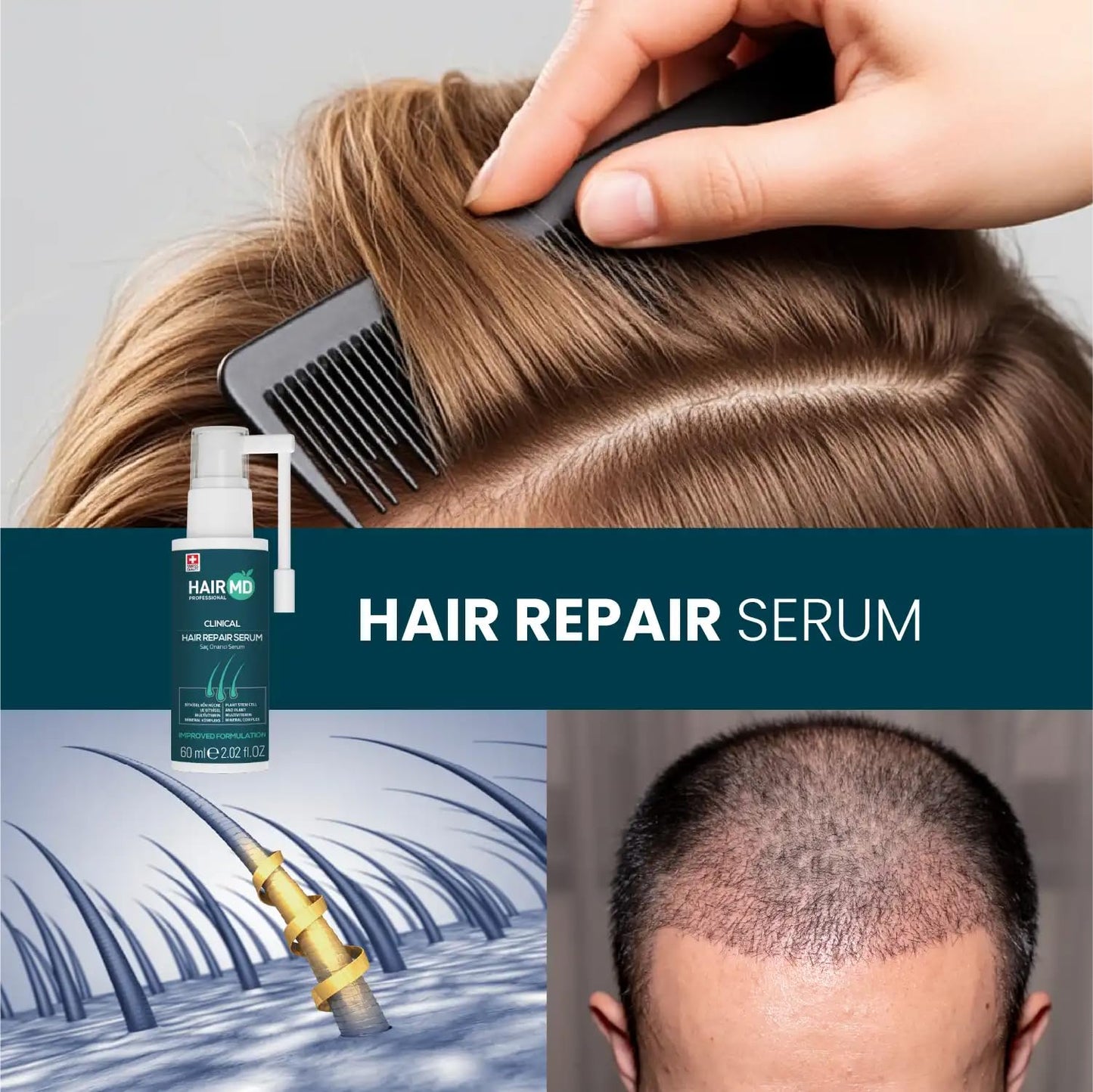 HairMD Transplant Clinical Repair Serum - 60ml Hair Regrowth Serum - Prevents Post-Transplant Hair Loss - Stimulates New Hair Growth - Fast and Effective Results - Gentle Formula