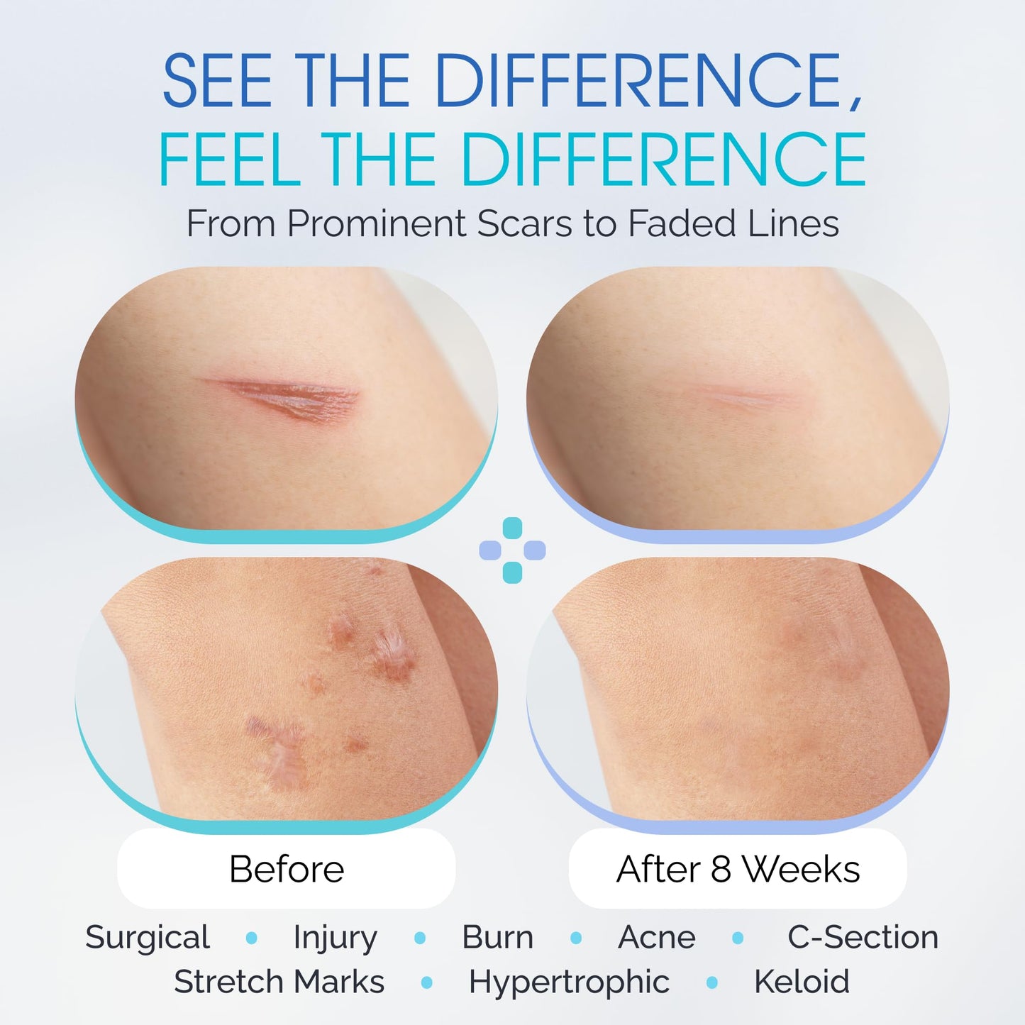 Silicone Scar Gel with Scar-Smoothing Tri-Roller Tip – Designed for Scar Massage – Medical-Grade Silicone for Surgical, C-Section & Acne Scars – Fragrance-Free & Hypoallergenic