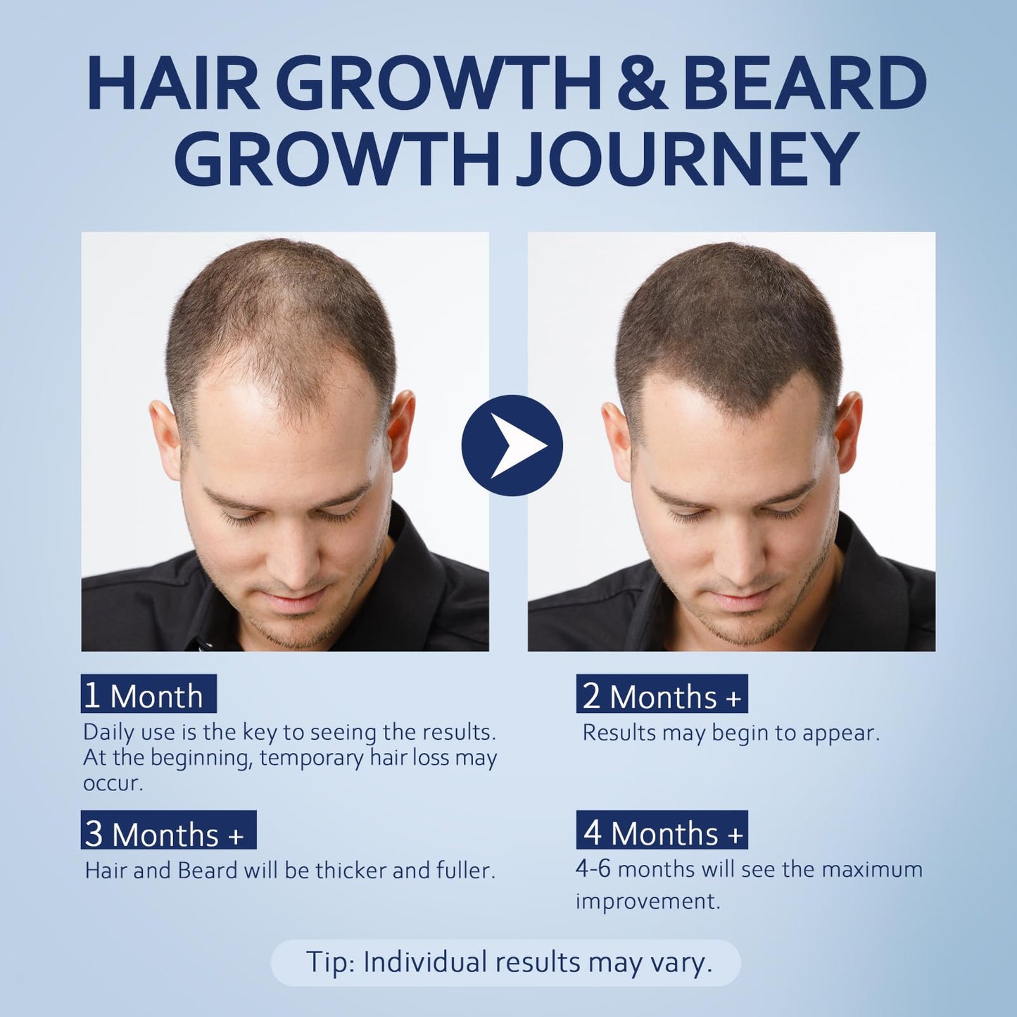 5% Minoxidil Hair Growth Serum for Men & Women with Biotin: Minoxidil for Men and Women, 5 Percent, Hair Regrowth Treatment, Extra Strength