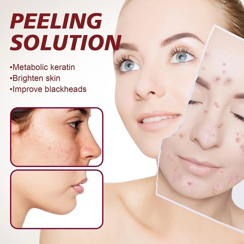 AHA 30% + BHA 2% Peeling Solution, Chemical Peel for Face at Home, BHA Liquid Exfoliant for Large Pores, Wrinkles & Fine Lines, 1.0 FlOz (1 PCS)