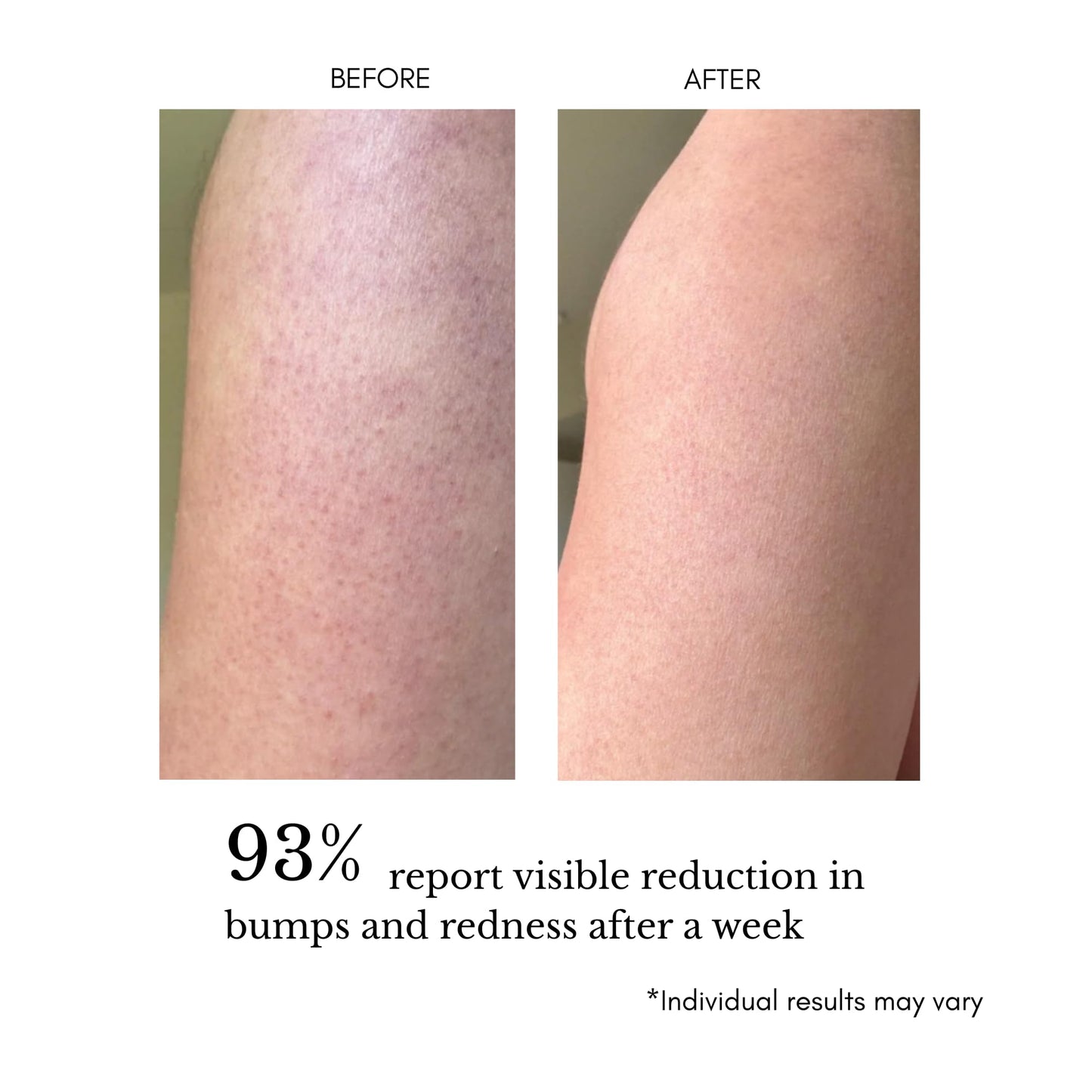 klarifyScience KP Treatment Serum - Triple Acid Complex (AHA + BHA + PHA) for Keratosis Pilaris | Gentle Daily Face and Body Serum for Rough Bumpy Skin, Strawberry Legs & Ingrown Hairs | 4 fl oz