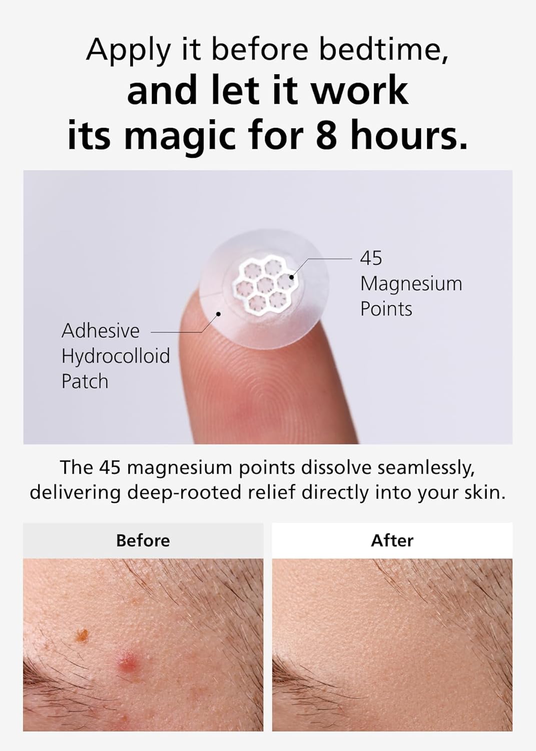Magnesium Acne Care Patches - Quick Calming Treatment | 30 Individually Wrapped Patches with Tweezers & Ampoule