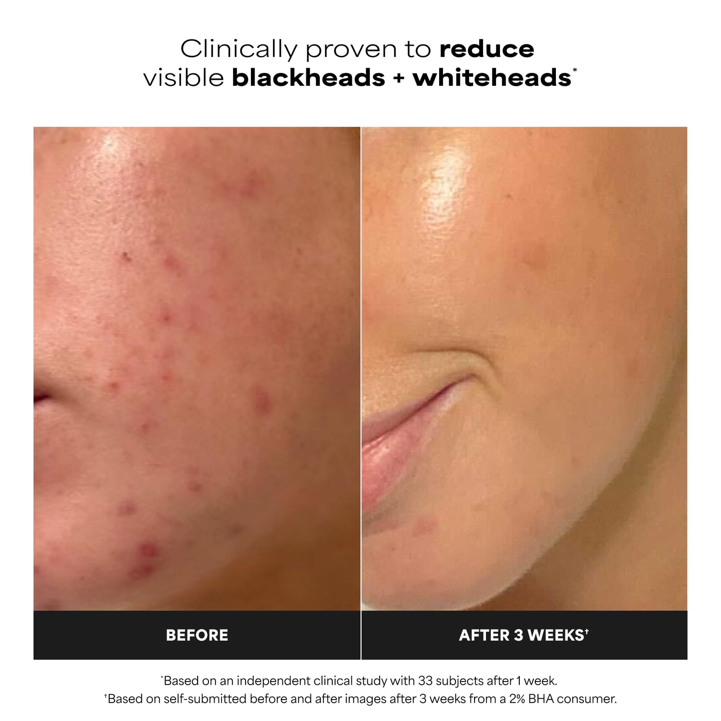 Paula's Choice SKIN PERFECTING 2% BHA Salicylic Acid Exfoliating Pads - Facial Exfoliant Pads for Blackheads, Enlarged Pores, Wrinkles & Fine Lines