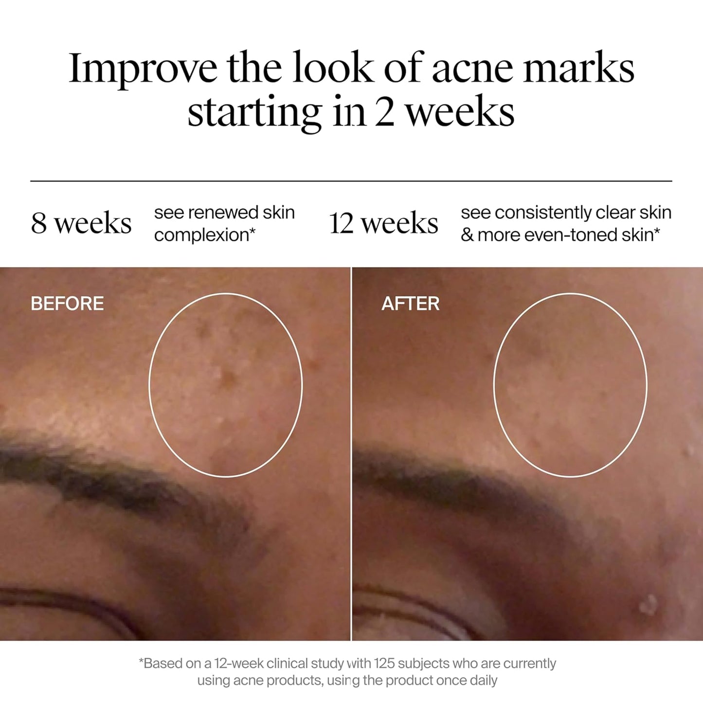 Neutrogena Evenly Clear Retinoid Adapalene Gel 0.1% - Acne Spot Treatment for Breakouts & Post-Acne Marks | 0.5 oz