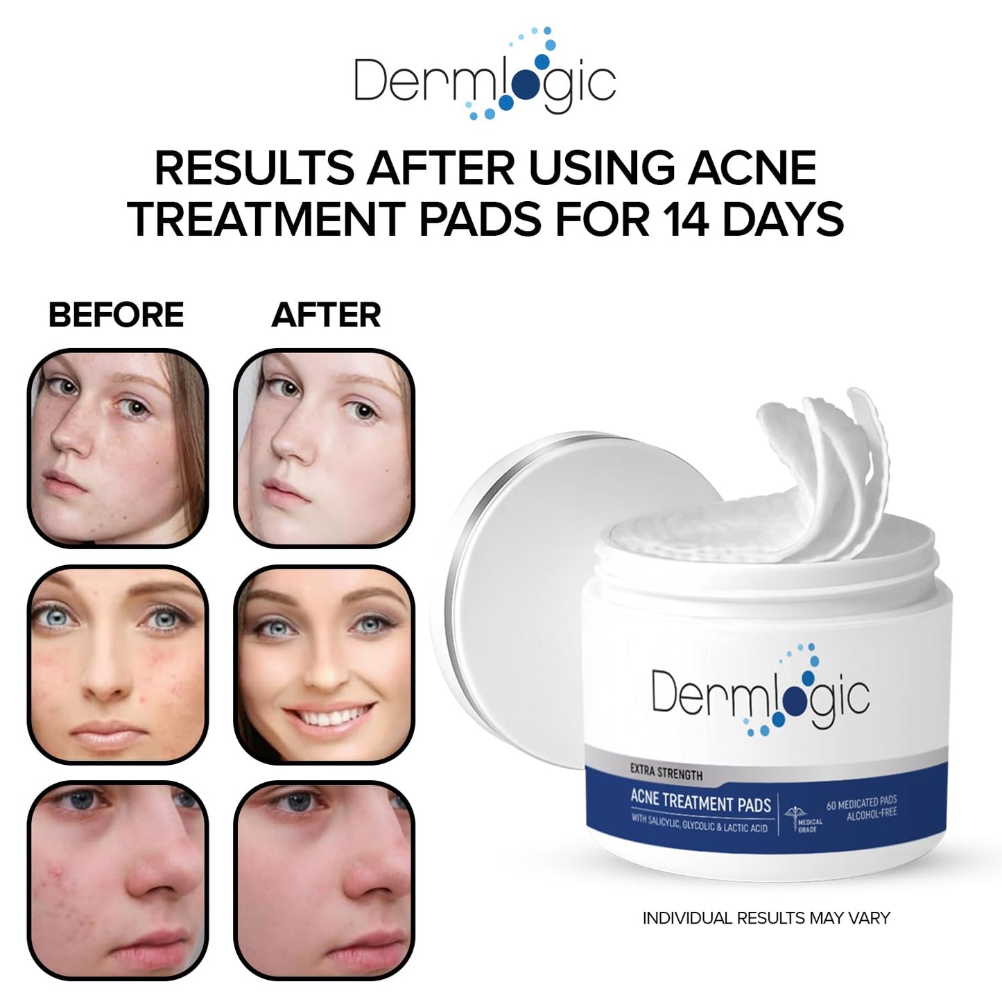 Acne Treatment Pads- Contains Salicylic, Glycolic, & Lactic Acid for Face & Body. Clears Away Clogged Pores, Oily Skin & Cystic Breakouts. Removes Dark Spots, Blackhead & Whitehead Pimples