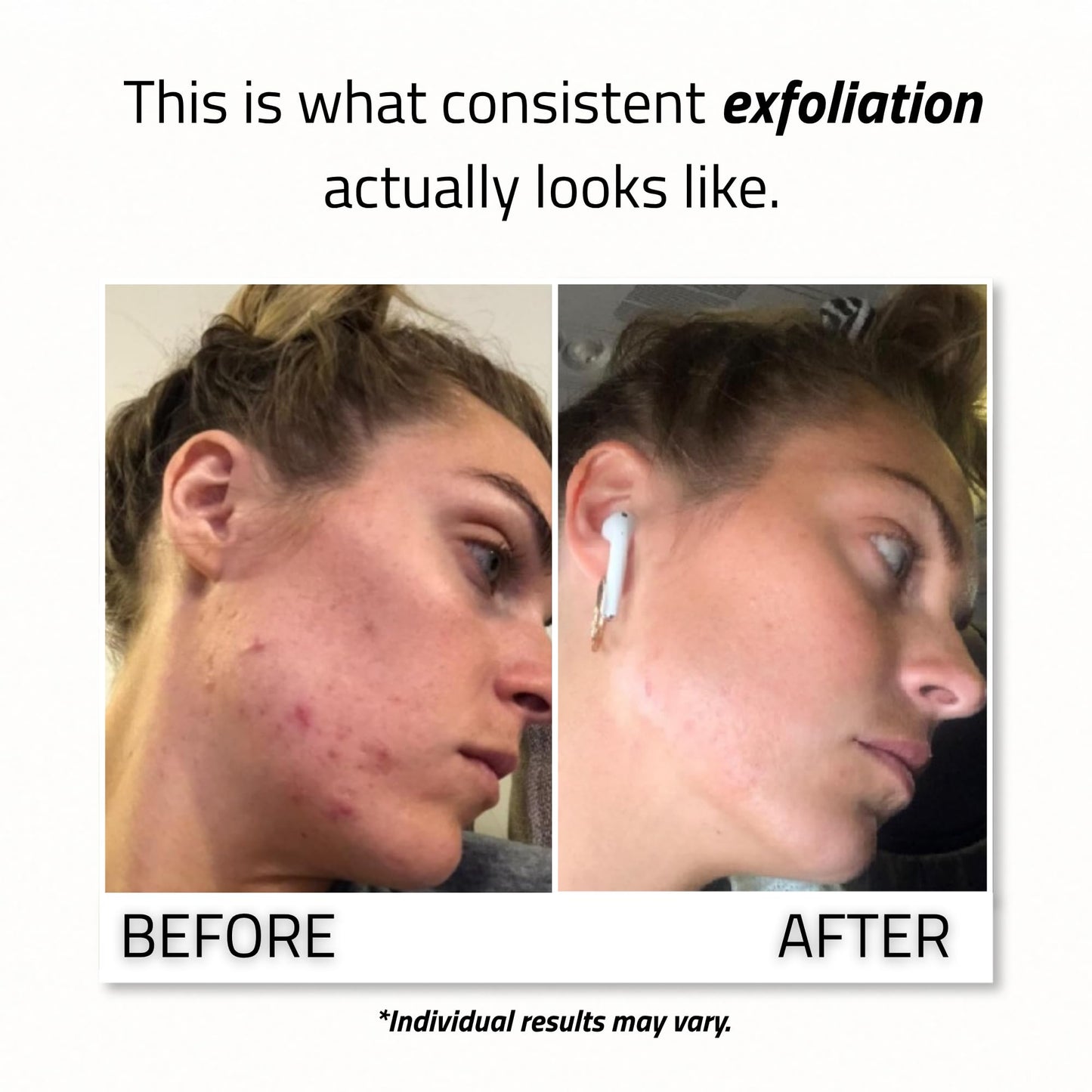 YEOUTH Glycolic Acid Face Peel 30% with Retinol and Green Tea, Glycolic Acid Peel Targets the Appearance of Uneven Texture and Dull Skin, 1oz