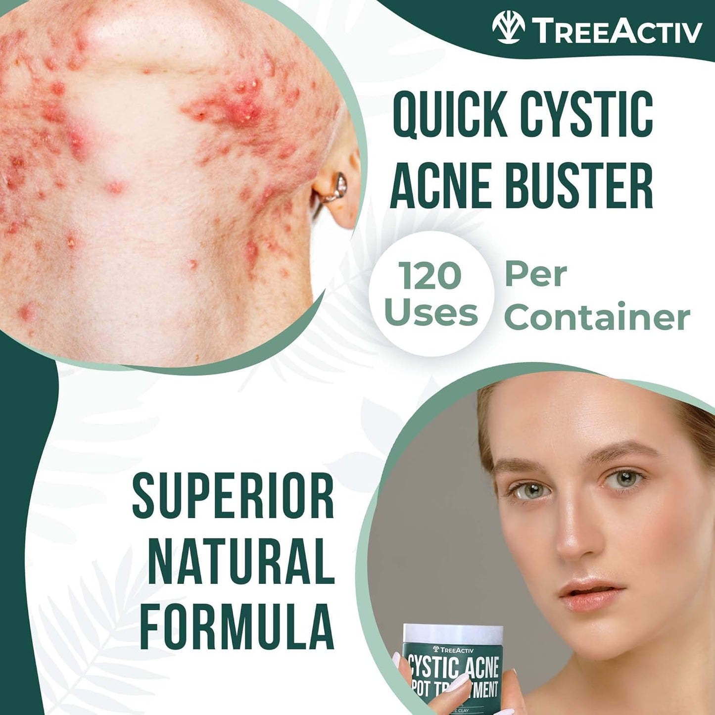 Cystic Acne Spot Treatment Paste - Sulfur & Tea Tree Oil | 0.5 oz for Deep Breakouts