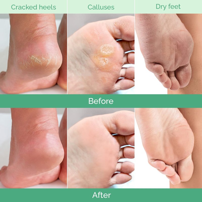 PLANTIFIQUE Foot Peeling Mask 4 Pack | Dermatologically Tested Repairs Heels & Removes Dry Dead Skin for Baby Soft Feet | Exfoliating Foot Peel Mask for Dry Cracked Feet | Peach