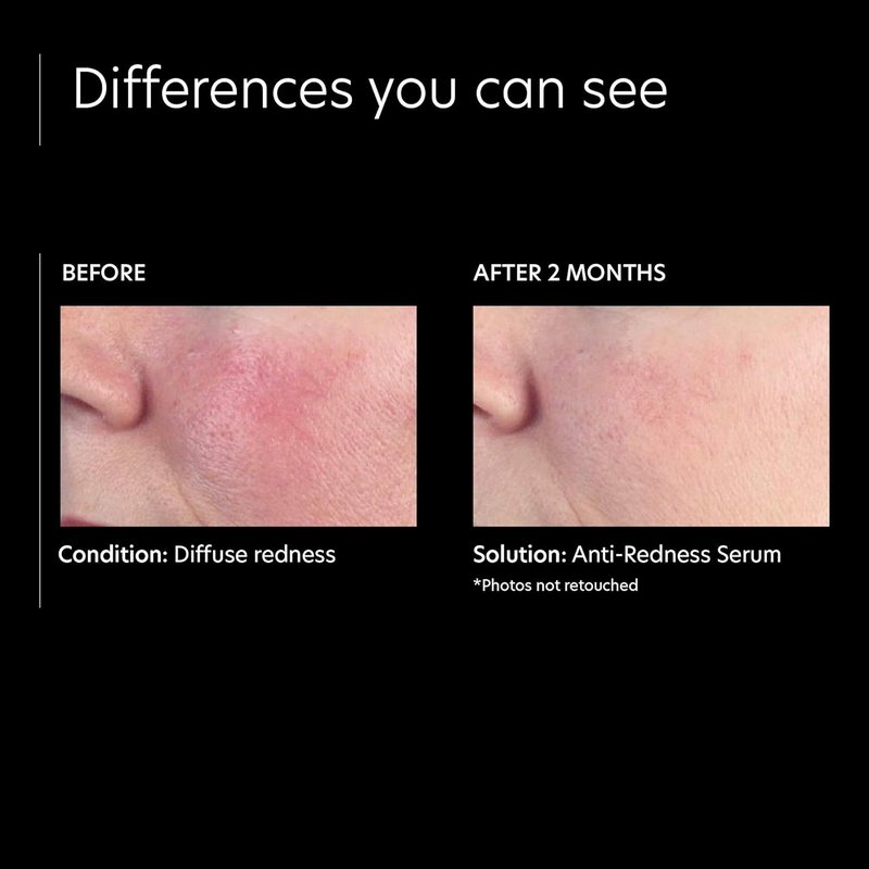 PCA SKIN Anti Redness Face Serum - Oil-Free Calming Treatment for Irritated Skin | 1 fl oz
