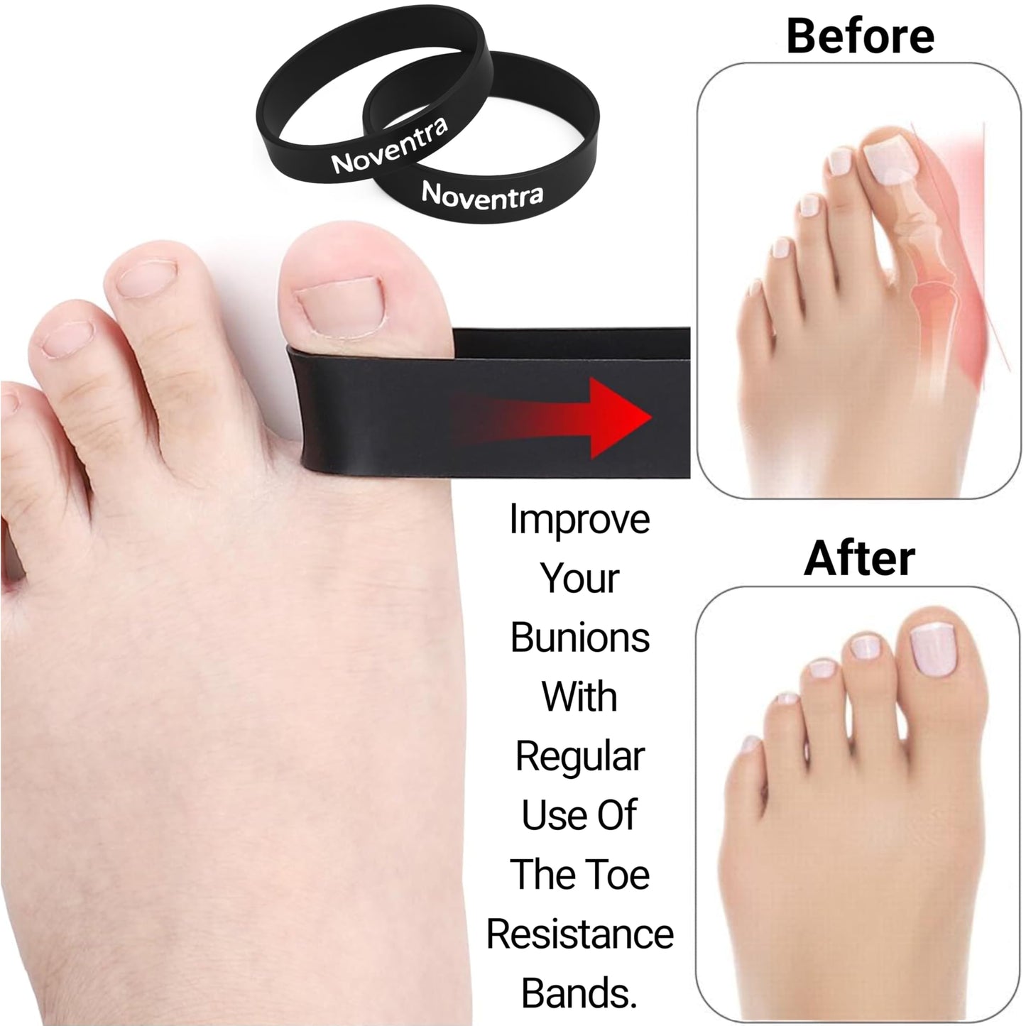 Plantar Fasciitis Relief Kit – Toe Spacers, Cork Massage Ball & Resistance Bands for Bunion Correction, Foot Pain, Yoga Stretching – Post Workout Massage Set with Travel Pouch