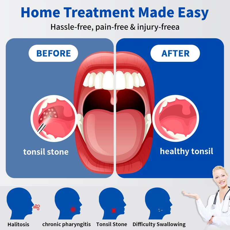 Tonsil Stone Remover with Camera，Tonsil Stone Removal Tool with LED Light，TonsilCleaner for Tonsil Stone Removal，Tonsillolith Removal Tool with 4 Head ，Attachments for iOS & Android (Black and Gold)