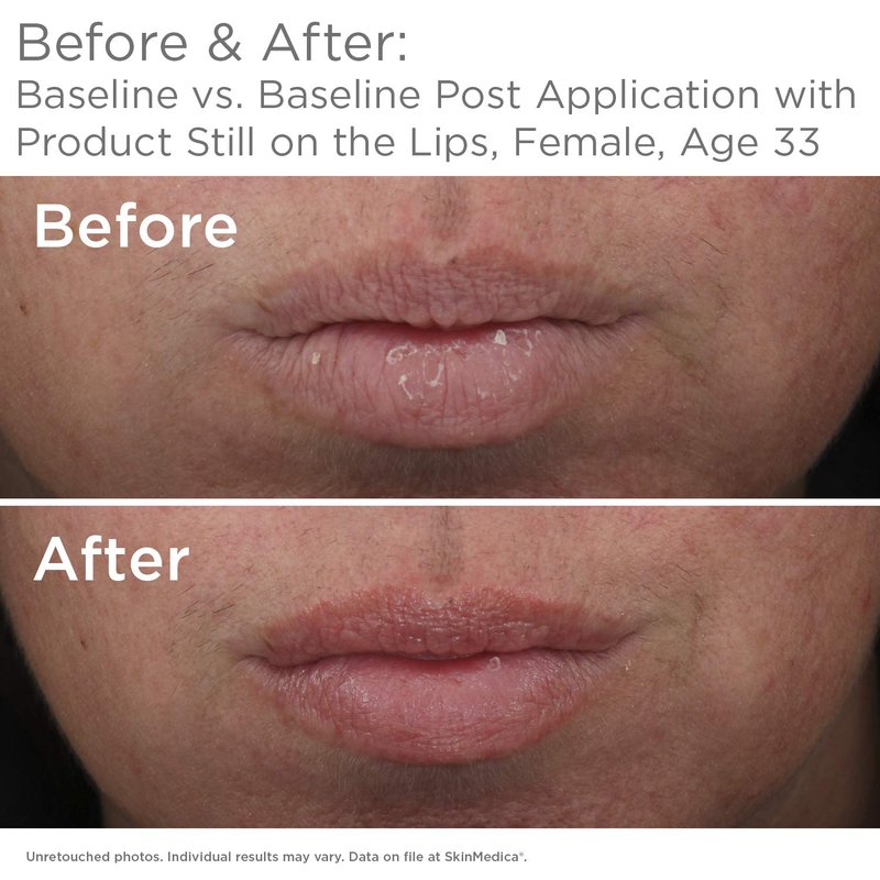 SkinMedica HA5 Lip Plumper - Hydrating & Volumizing Lip Treatment for Fuller, Smoother Lips | 0.05 Oz