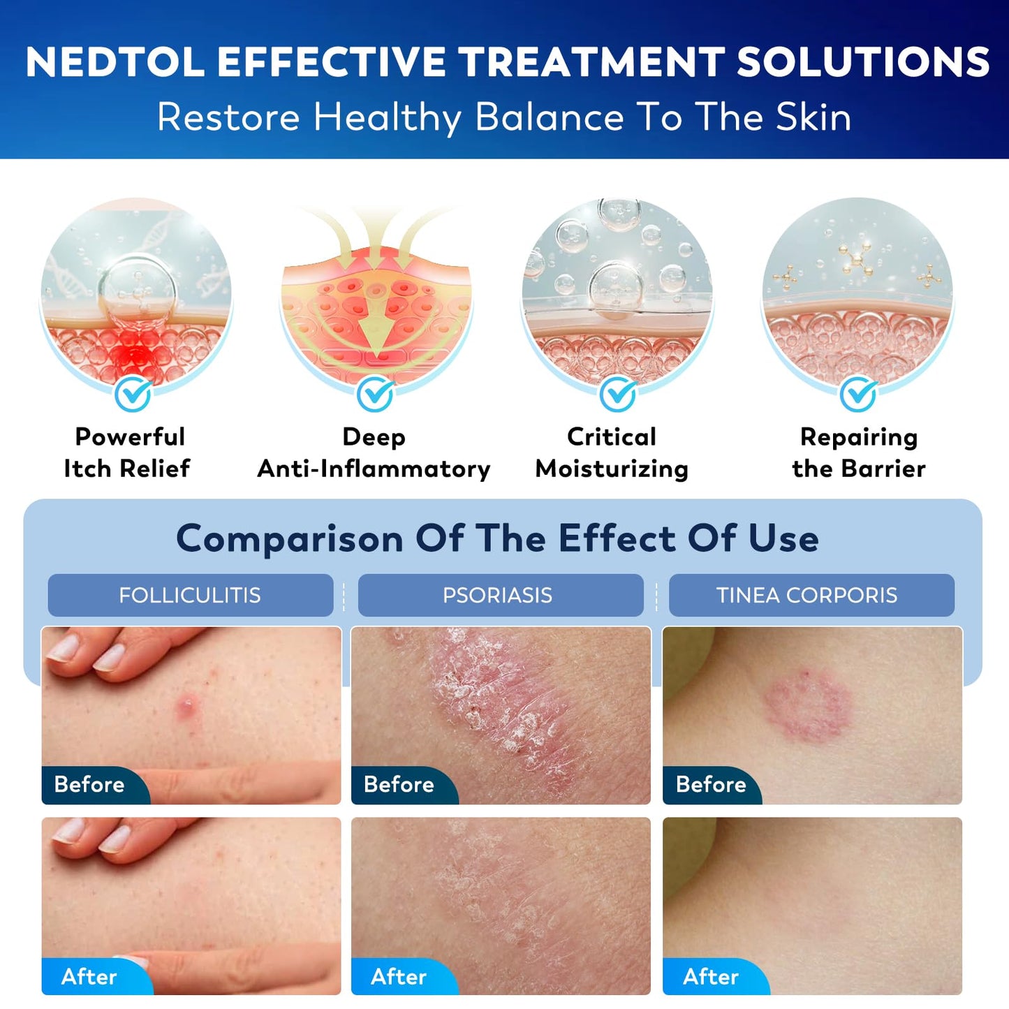 Nedtol Folliculitis Treatment Cream, 7X Stronger Ointment, for use on Hair-Growing Areas, relieves itching, Redness, and Bumps, Powerful Skin Care – 130g