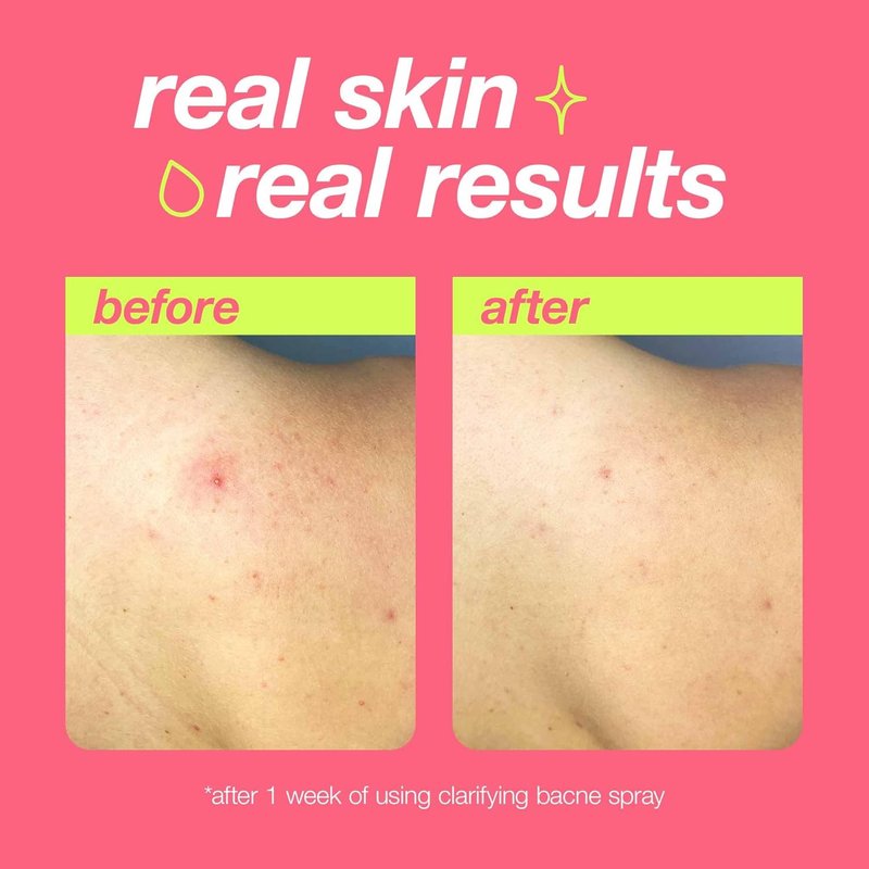 Dermalogica Clear Start Bacne Spray | Back Acne Treatment with Salicylic Acid & Tea Tree Oil - 6 fl oz