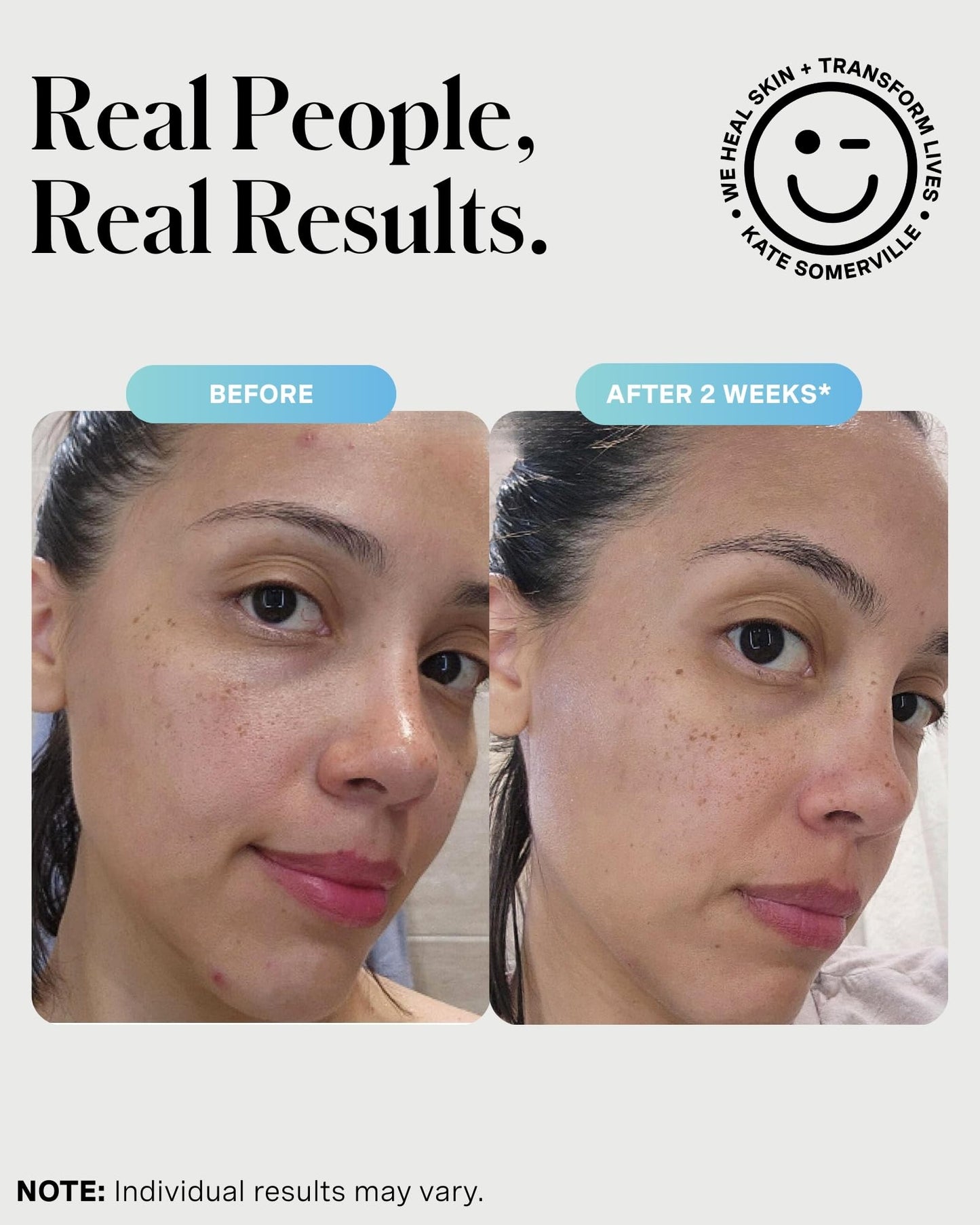 Kate Somerville EradiKate 3% Sulfur Daily Foaming Cleanser Acne Treatment – Clinically Formulated Medicated Face Wash Balances Skin & Cleans Pores, 4 Fl Oz
