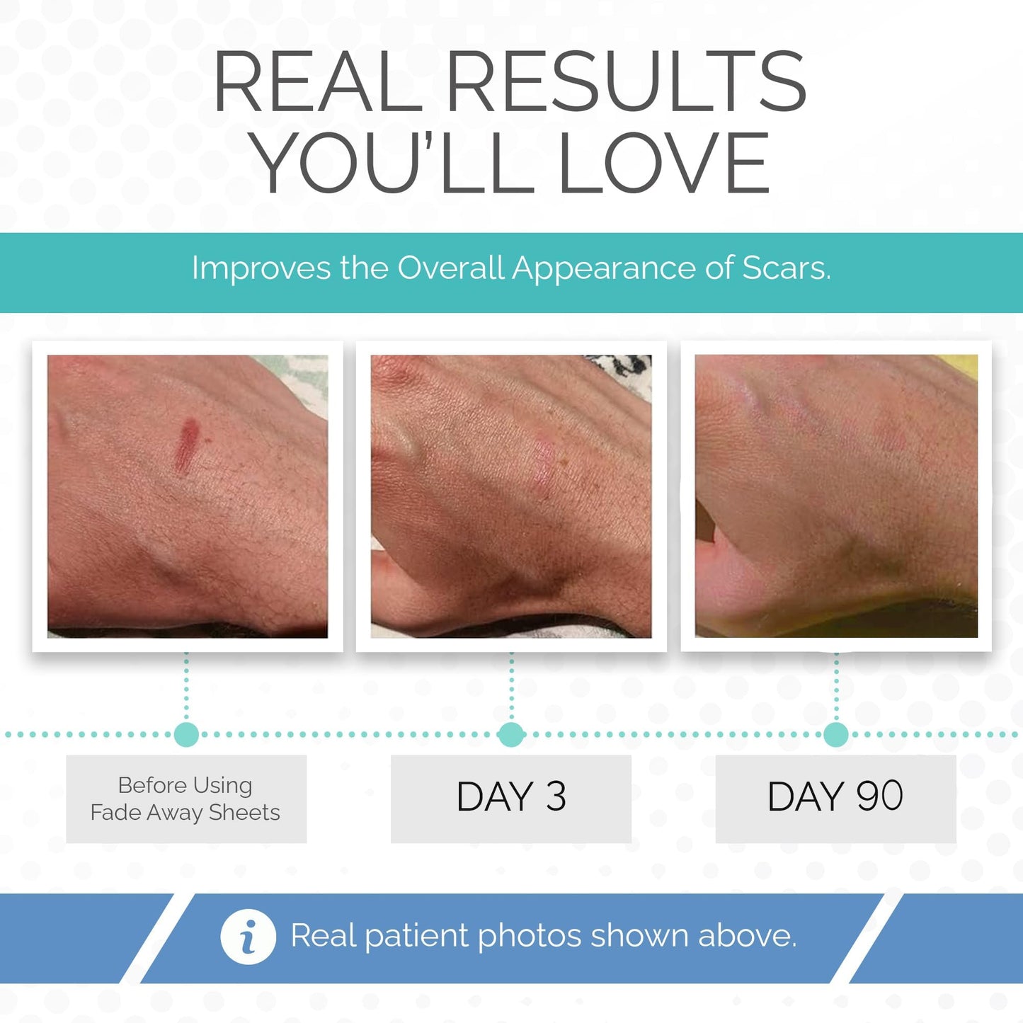 Clinically Proven Silicone Scar Sheets – Medical Grade Tape for Surgery, C-Section, Keloids & Tummy Tuck Scars