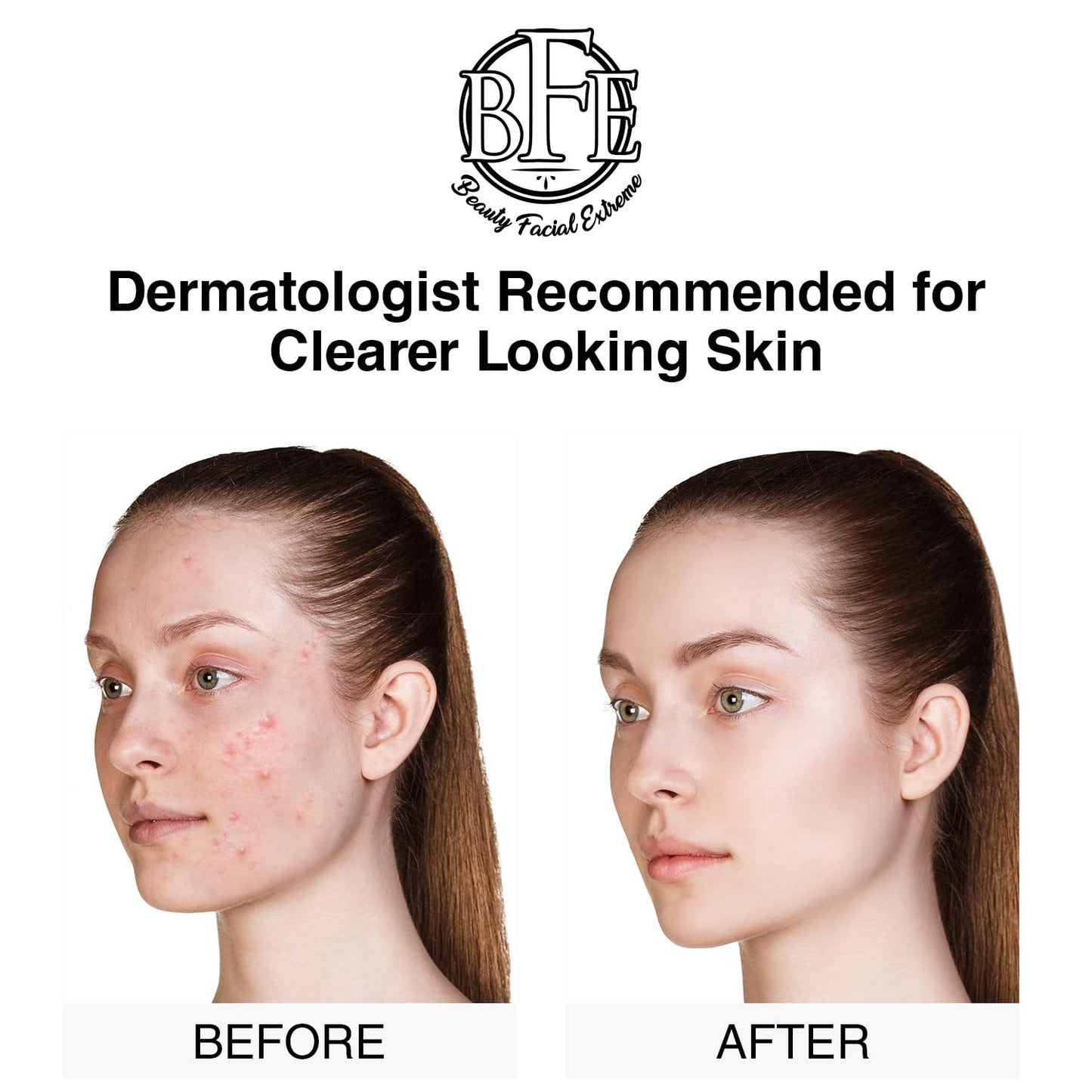 Acne Treatment Pads - Clear Cystic Breakouts & Clogged Pores | Improve Skin Texture & Reduce Dark Spots