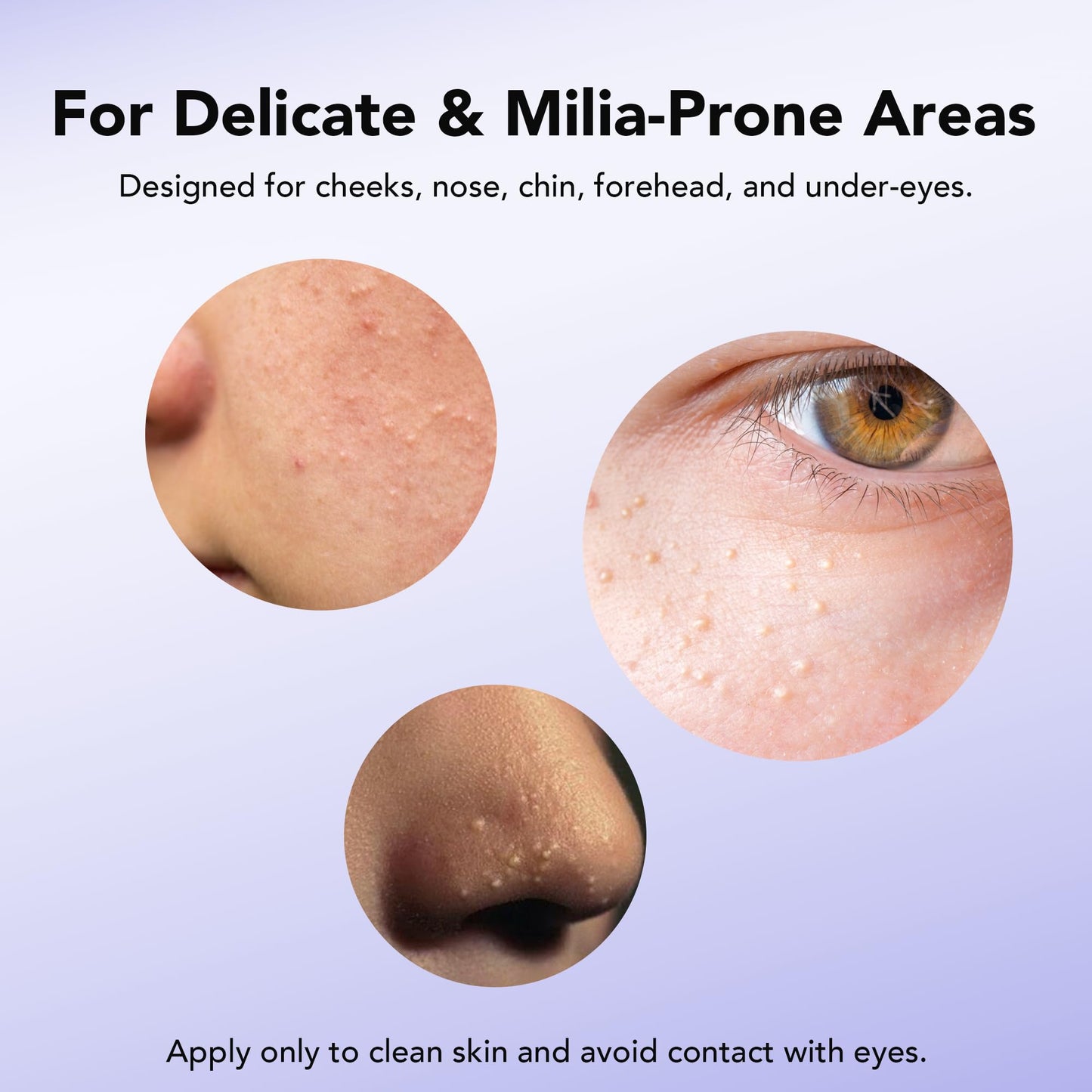 DERMFREE MILIA REMOVER 30 mL Milia Remover Treatment, Milia Spot Treatment with Salicylic Acid Milia Acne Serum Clearing Skin Essence