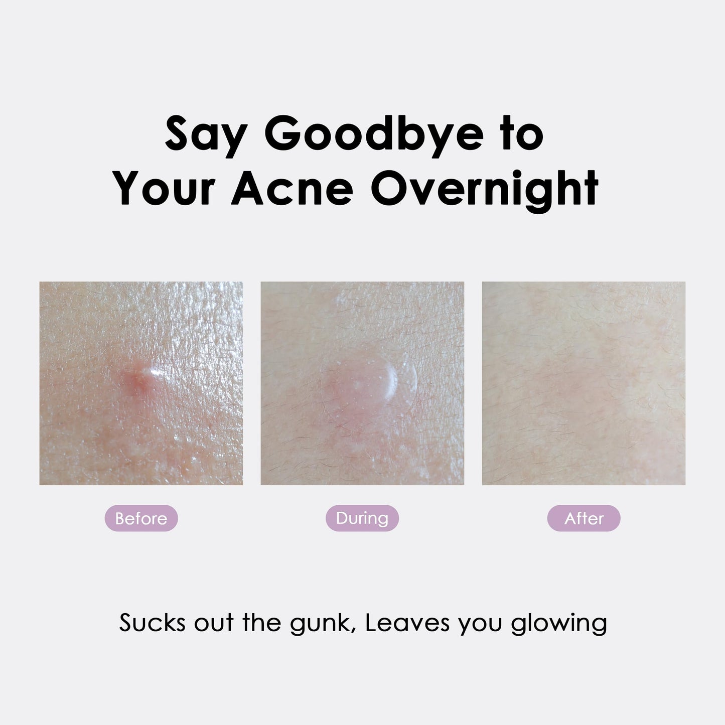 glowiest ASAP Active Spot Alleviating Patch 44 Patches (DUO) 8mm, 10mm, 12mm Spot patches - Premium Hydrocolloid Dressing Dots | Simple & Easy Active Treatment (Pack of 2)