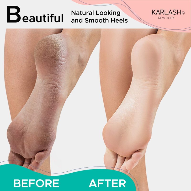 Karlash Professional Pedicure Foot Pumice Stone for Feet Skin Callus Remover and Scrubber for Dead Skins 2 Sided (Pack of 4)