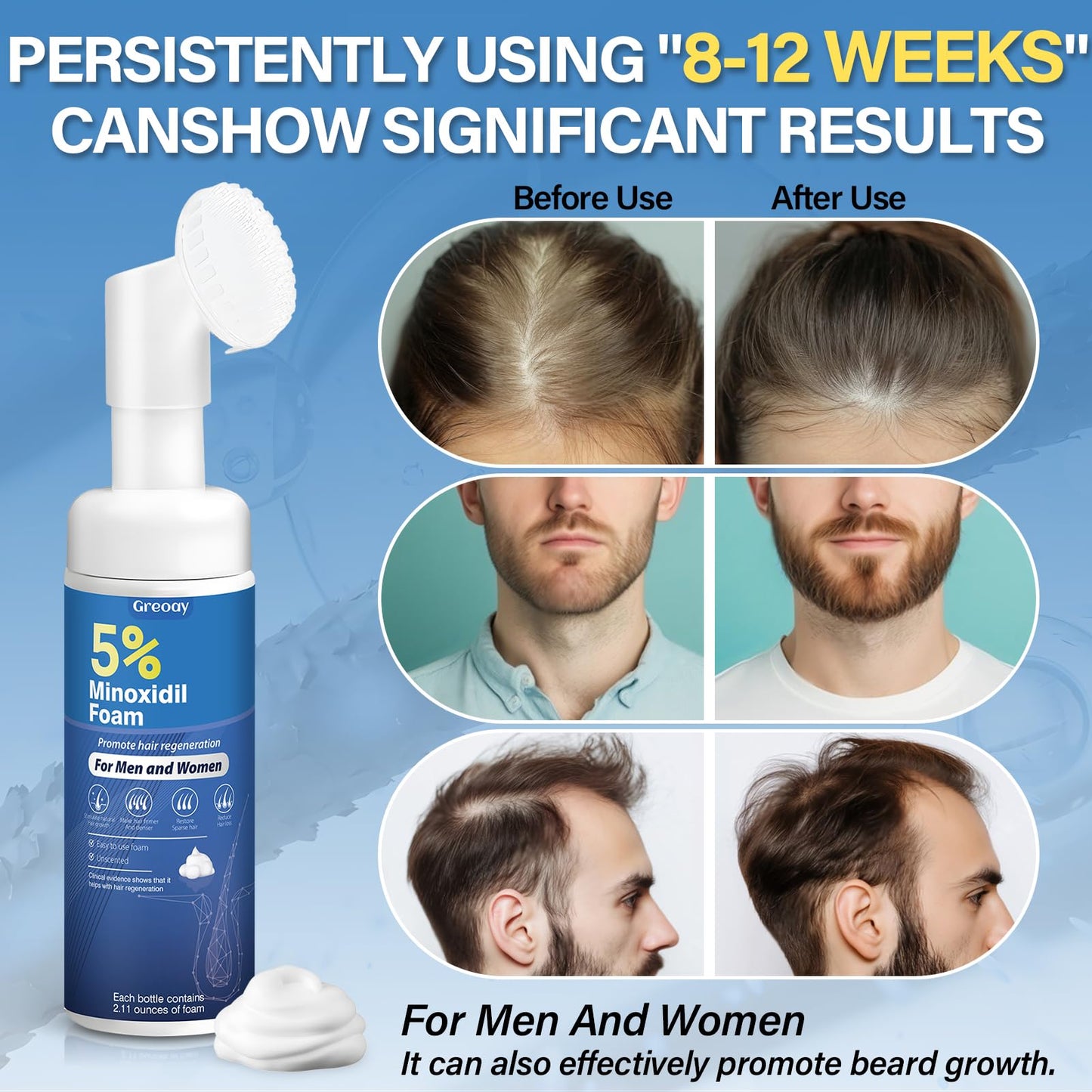 5% Minoxidil Hair Growth Foam Men and Women
