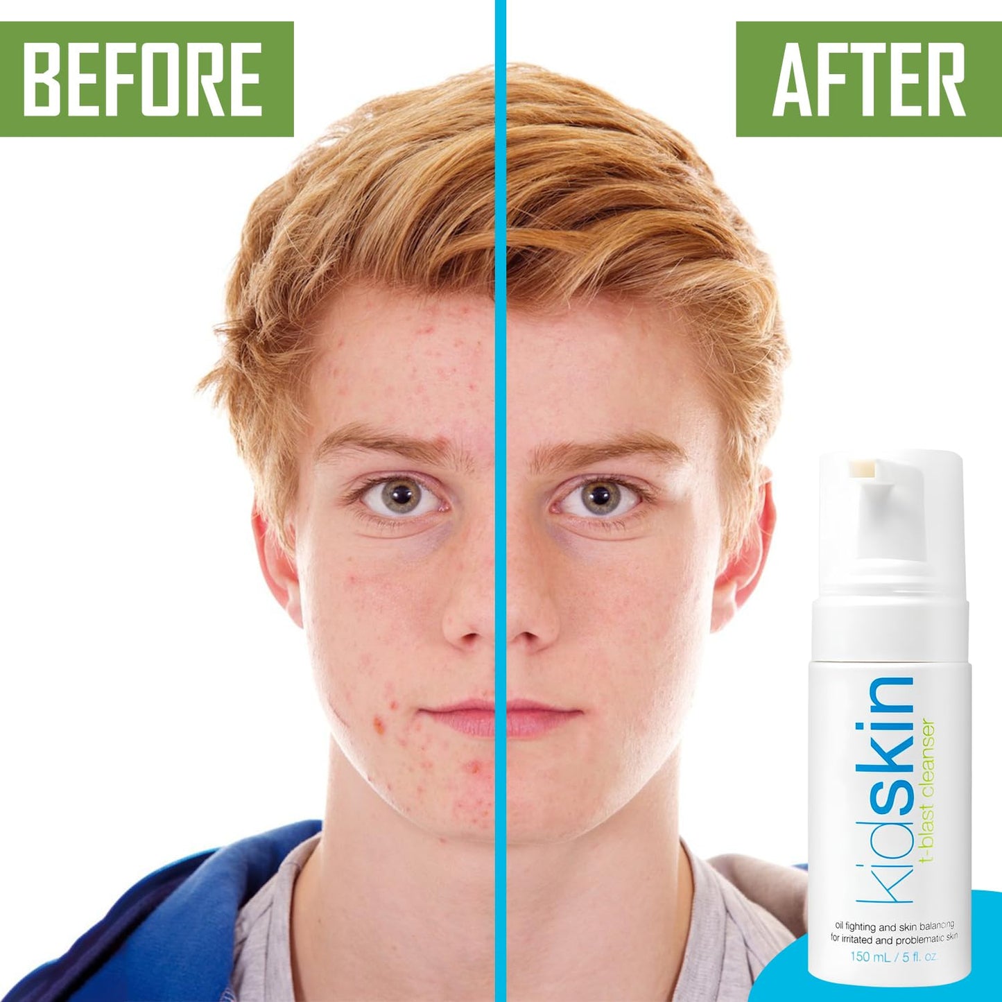 Kidskin T-Blast Facial Cleanser, Gentle Face Wash with Tea Tree Oil, Spot Skin Care for Kids and Teens, Non-Drying Natural Cleanser for Oily or Dry, Acne-Prone Skin, 150 ml 5.0 fl oz.
