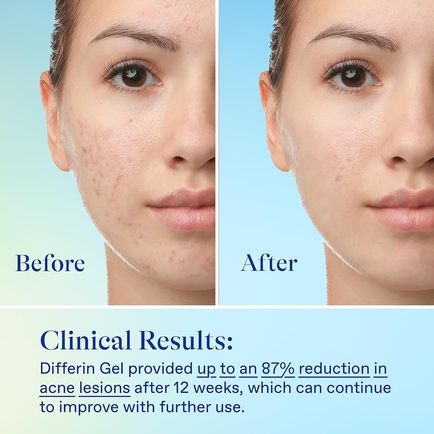 Differin Acne Treatment Kit - Gel Retinoid & Benzoyl Peroxide Wash for Acne-Prone Skin | 0.1% Adapalene, 5% Benzoyl Peroxide