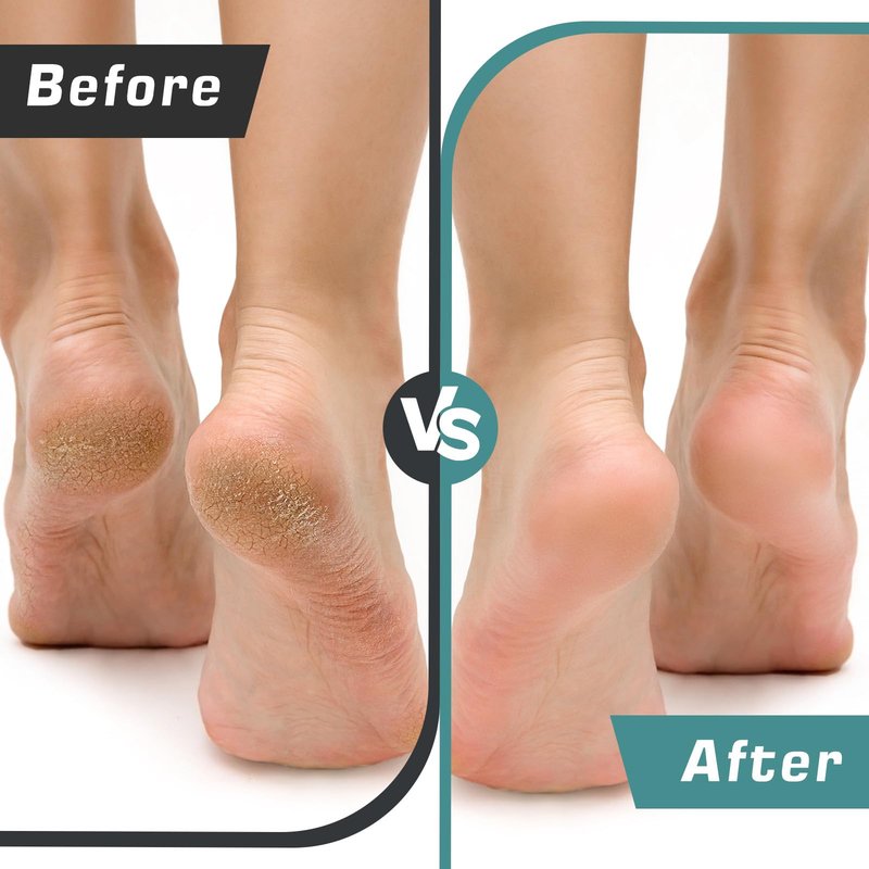 Electric Foot Callus Remover, Electric Foot File - Callus Remover for Feet, Feet Sander with 60 pcs Replacements Sanding Disc, Professional Pedicure Tool for Dead Skin, Black