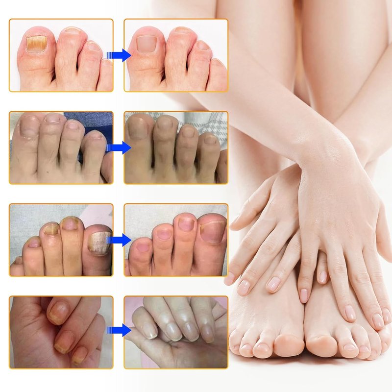 Extra Strength Toenail Treatment | 8-Hour Overnight Repair for Ingrown Nails, Strengthens Brittle Nails, Hypoallergenic (64 Patches)