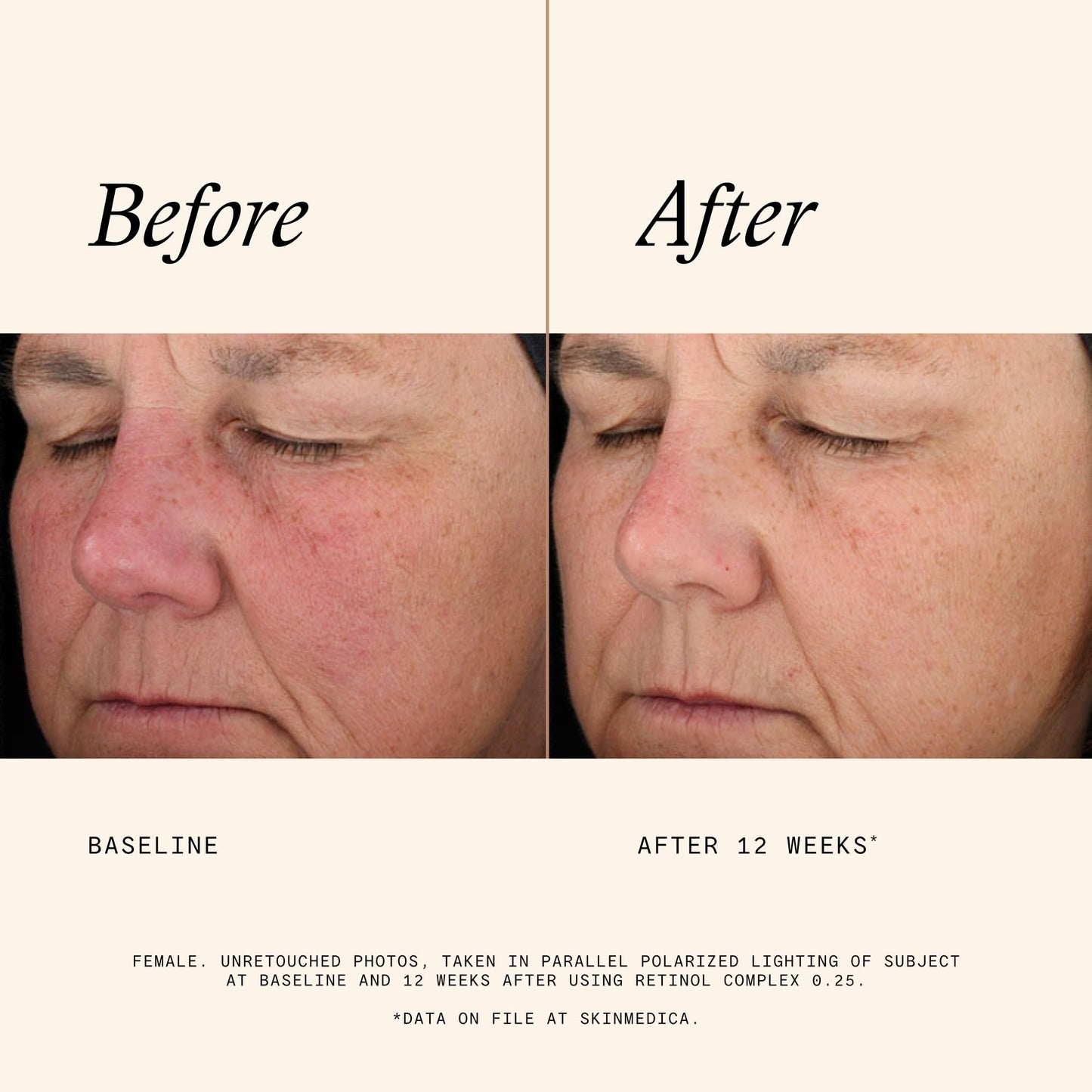 SkinMedica Retinol Serum 0.25 Complex - Serum for Face, Age-Defying Advanced Retinol Cream That Renews Skin and Diminishes the Appearance of Fine Lines and Wrinkles - 1 Fl Oz