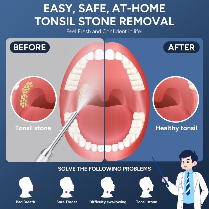 Tonsil Stone Remover with Camera - Upgraded Visual Tonsil Stone Removal Kit with 6 LED Light -Tonsil Stone Remover Tool with 1080P Camera, 5 Stainless Steel Heads, Irrigator, for iOS & Android(White)