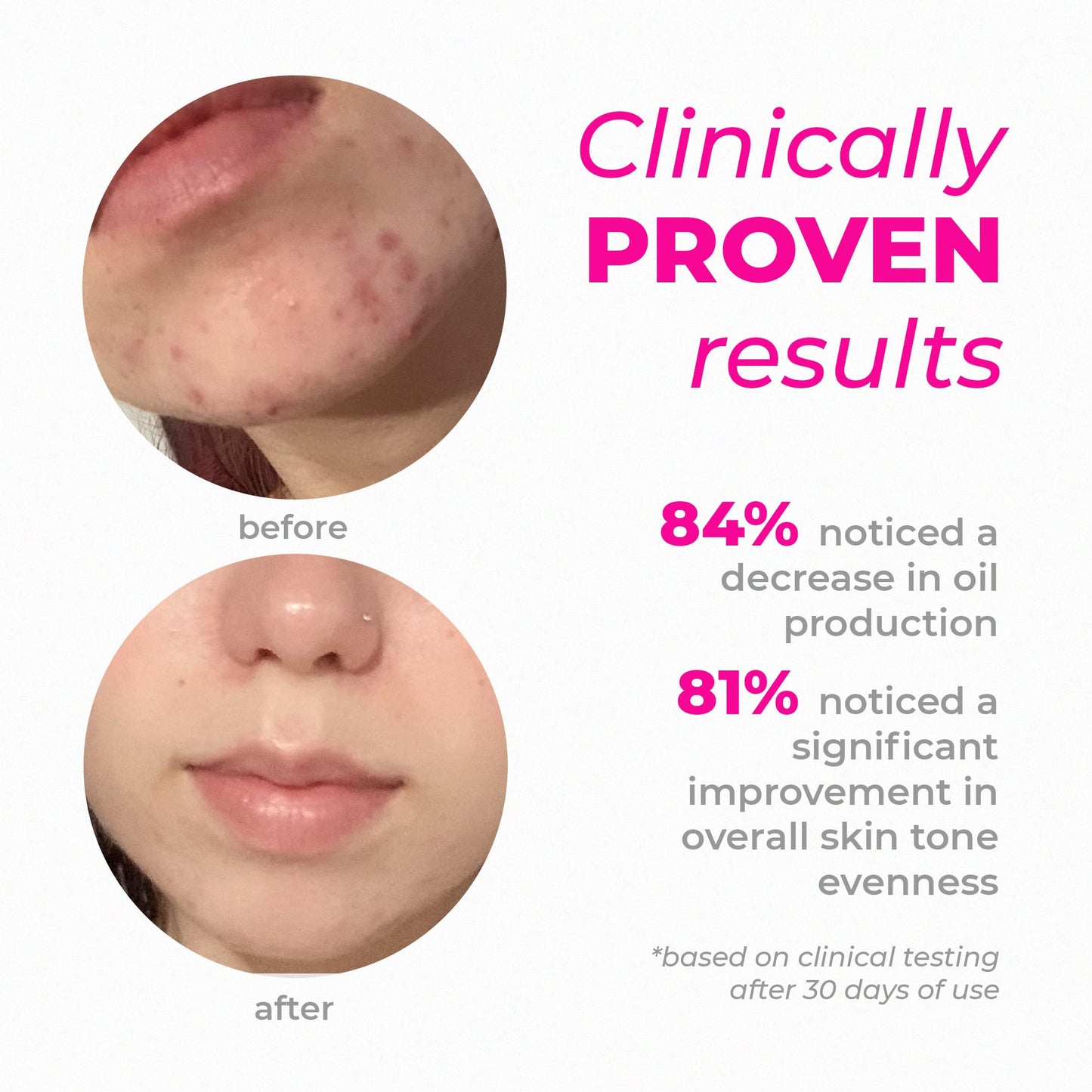 Creamy Skincare Mandelic Gel 7% – Exfoliating & Blemish Control Face Gel with Mandelic Acid, Alpha-Arbutin, Allantoin & Hypskin – Gentle Formula 1 fl oz/30mL