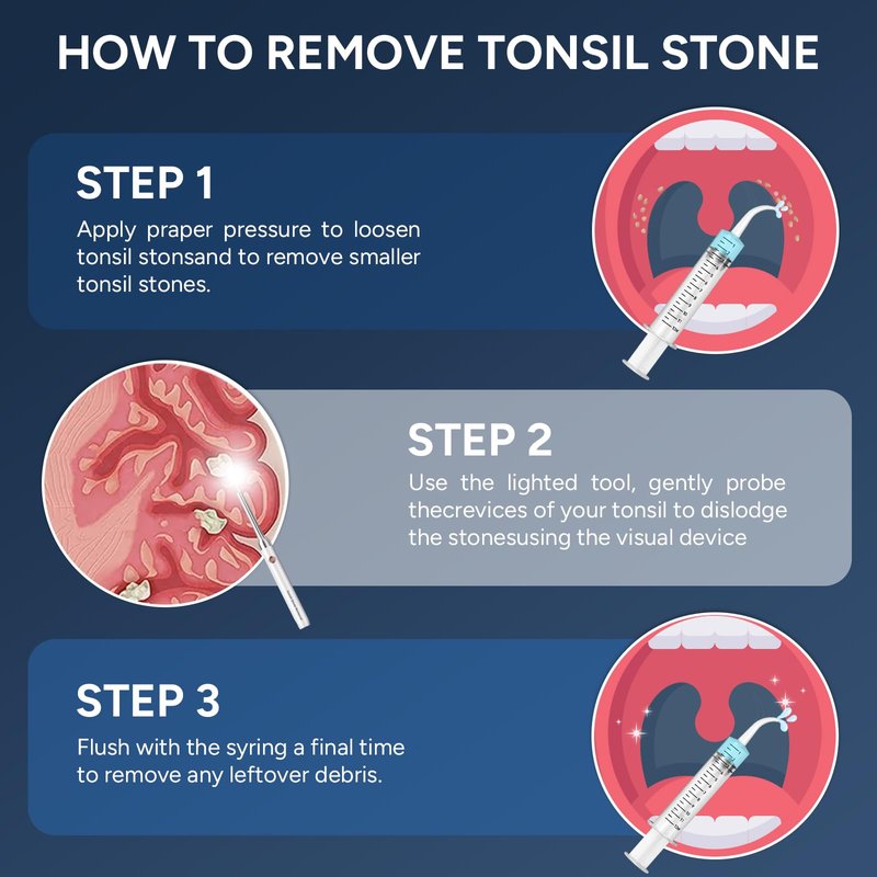 Tonsil Stone Remover with Camera - Upgraded Visual Tonsil Stone Removal Kit with 6 LED Light -Tonsil Stone Remover Tool with 1080P Camera, 5 Stainless Steel Heads, Irrigator, for iOS & Android(White)