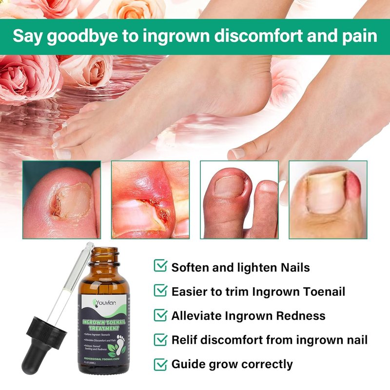 Ingrown Toenail Treatment Kit - Relieve Pain & Repair Issues | Safe Home Solution