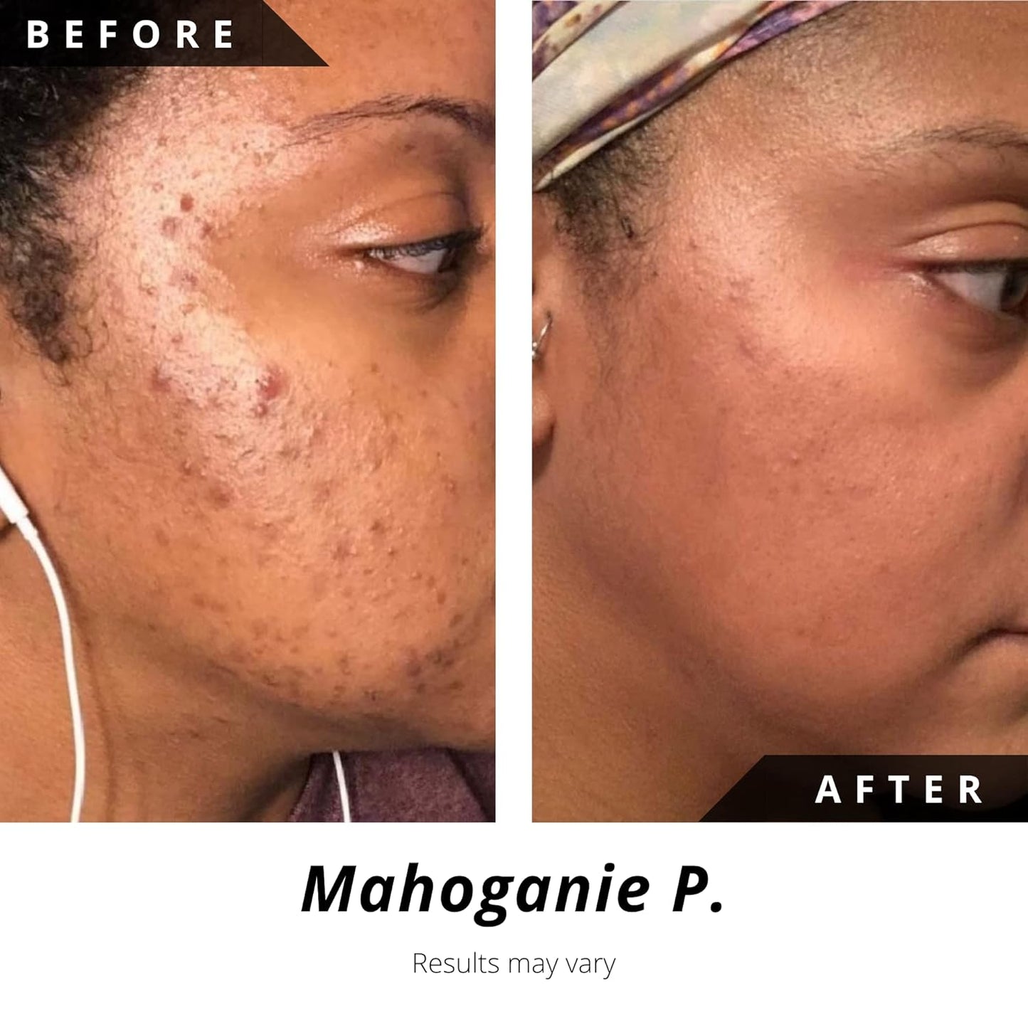 Acne Scar Treatment - Three Step Hyperpigmentation Repair Set | Normal to Oily Skin, Dark Spot Remover