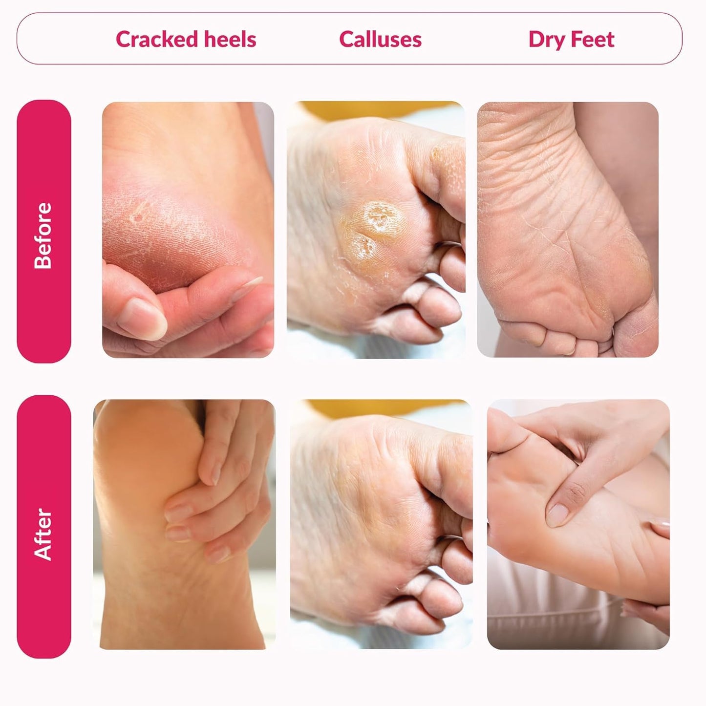 Summer Foot Peeling Mask That Removes Dead Skin - Dermatologically Tested Callus Remover for Dry Cracked Feet - Exfoliating Foot Peel Mask for Baby Soft Feet - Cucumber & Urea Extracts