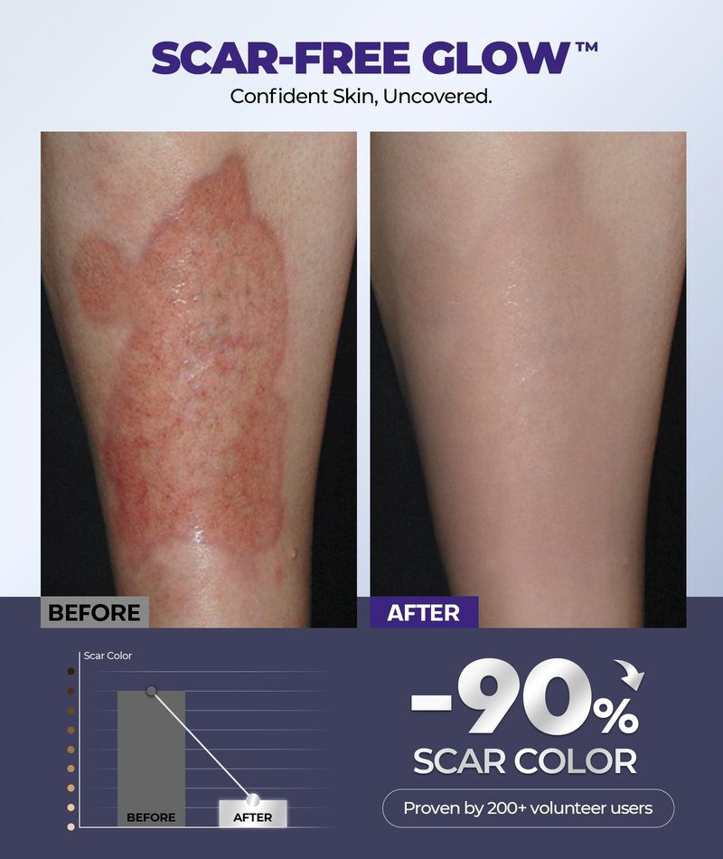 Silicone Scar Cream with 6.7% Active Ingredients, Scar Gel Visible in 2 Weeks, Moisturizing Scar Removal Clinically Show for Surgical, C-Section, Keloid, Acne & Burn Scars, Stretch Mark Cream(55ML)