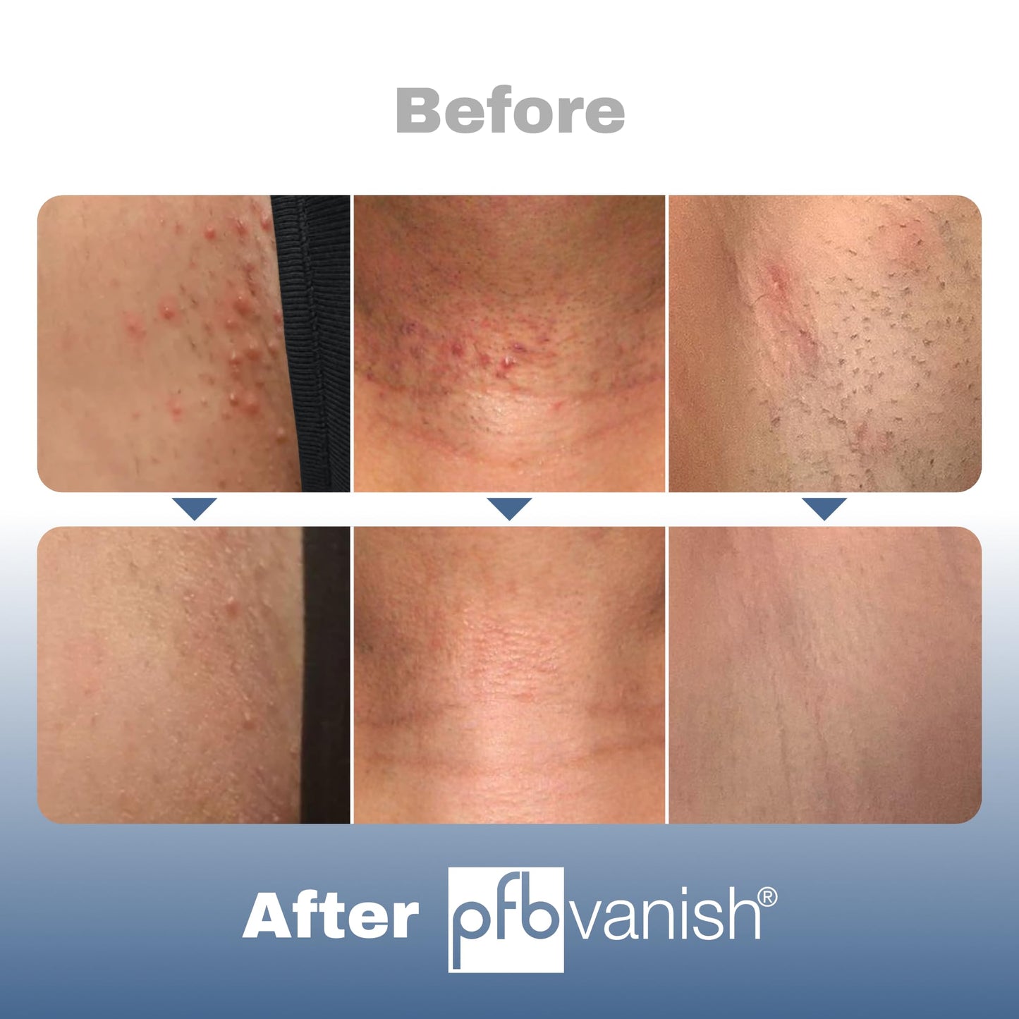 PFB Vanish Razor Bump Stopper Roll On Shaving Gel - Skin Care Treatment for Ingrown Hairs and Razor Burns, 93g