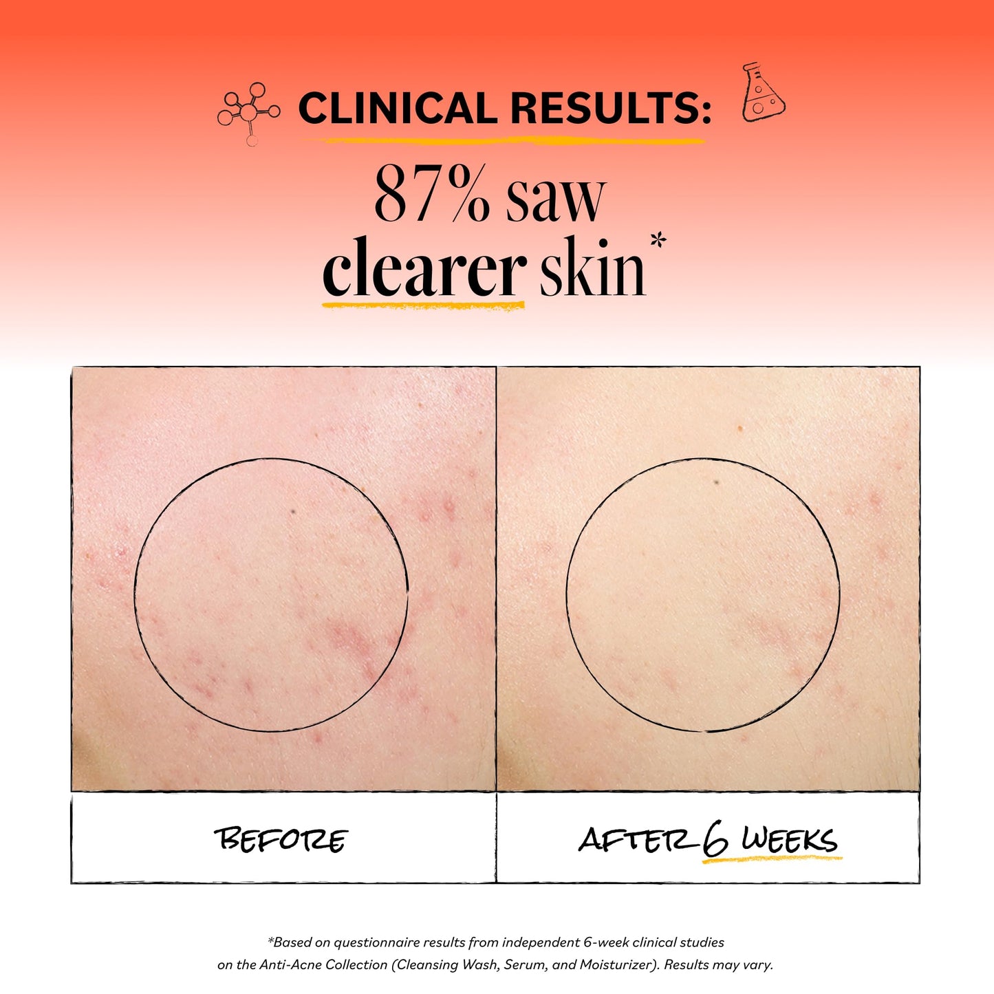 DERMA E Acne Spot Treatment, Acne Blemish Control Treatment Serum, 2 Fl Oz, Clinically Studied to Help Fight Blackheads, Breakouts and Cystic Acne for Clearer Looking Skin