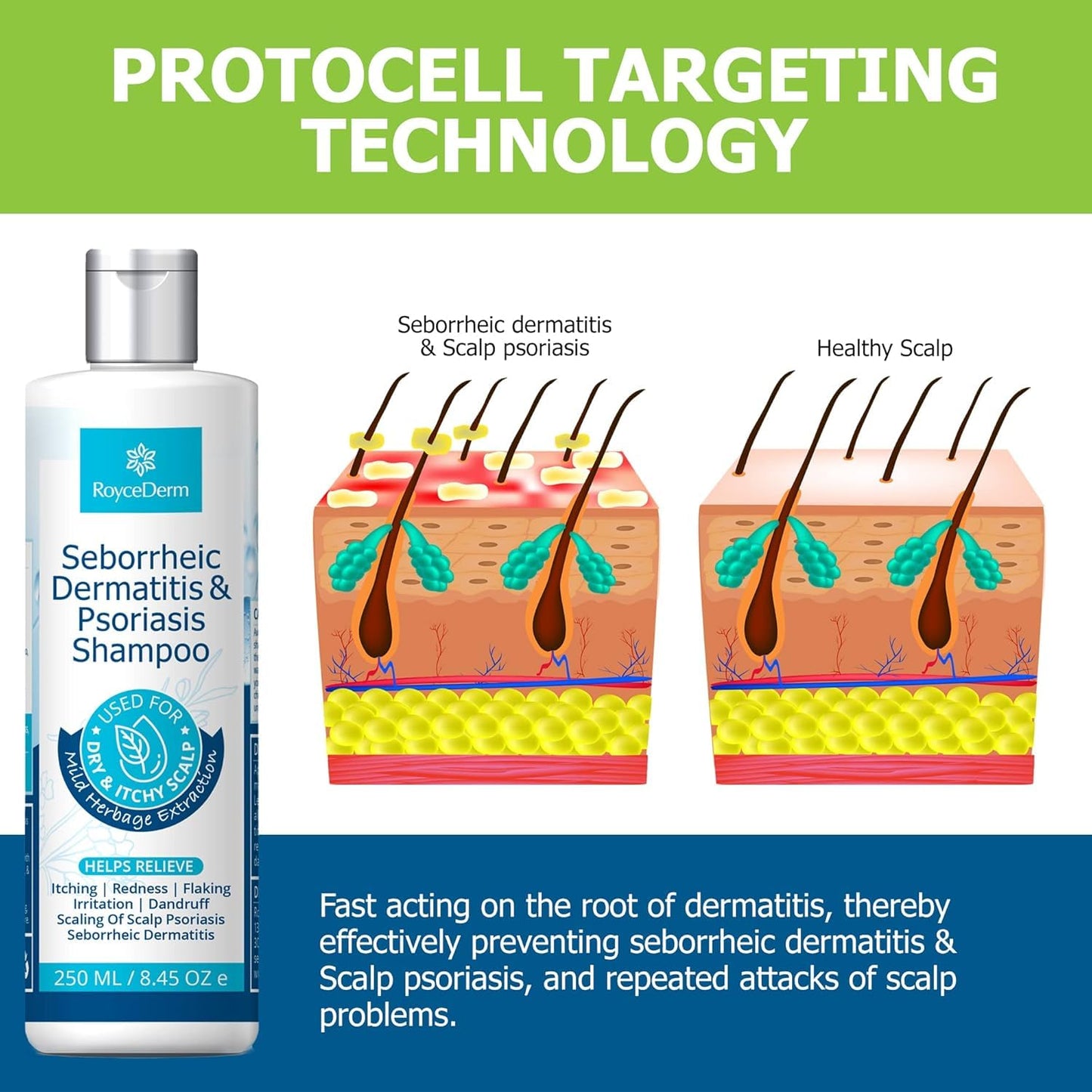 Roycederm Seborrheic Dermatitis & Psoriasis Shampoo for Dandruff - Helps Relieve Itching, Flaking & Scaling, Dry Itchy Scalp