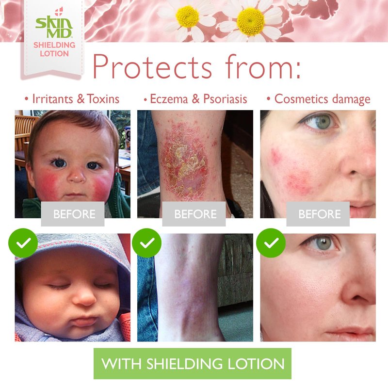 Skin MD Shielding Lotion Hydrating Body Lotion for Sensitive Skin with Dispenser | Non-Greasy, Fast-Absorbing Moisturizer with Plant-Based Ingredients, Eczema & Psoriasis Relief - 8oz