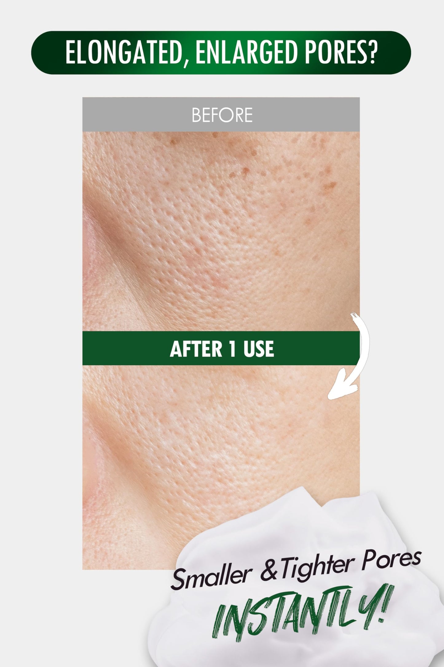 [K-Beauty] Neogen Dermalogy Pore Zero Peeling Mousse | All-in-One Foaming Exfoliating Face Wash Visibly Firming, Tightening & Lifting Skin 3.38 fl oz